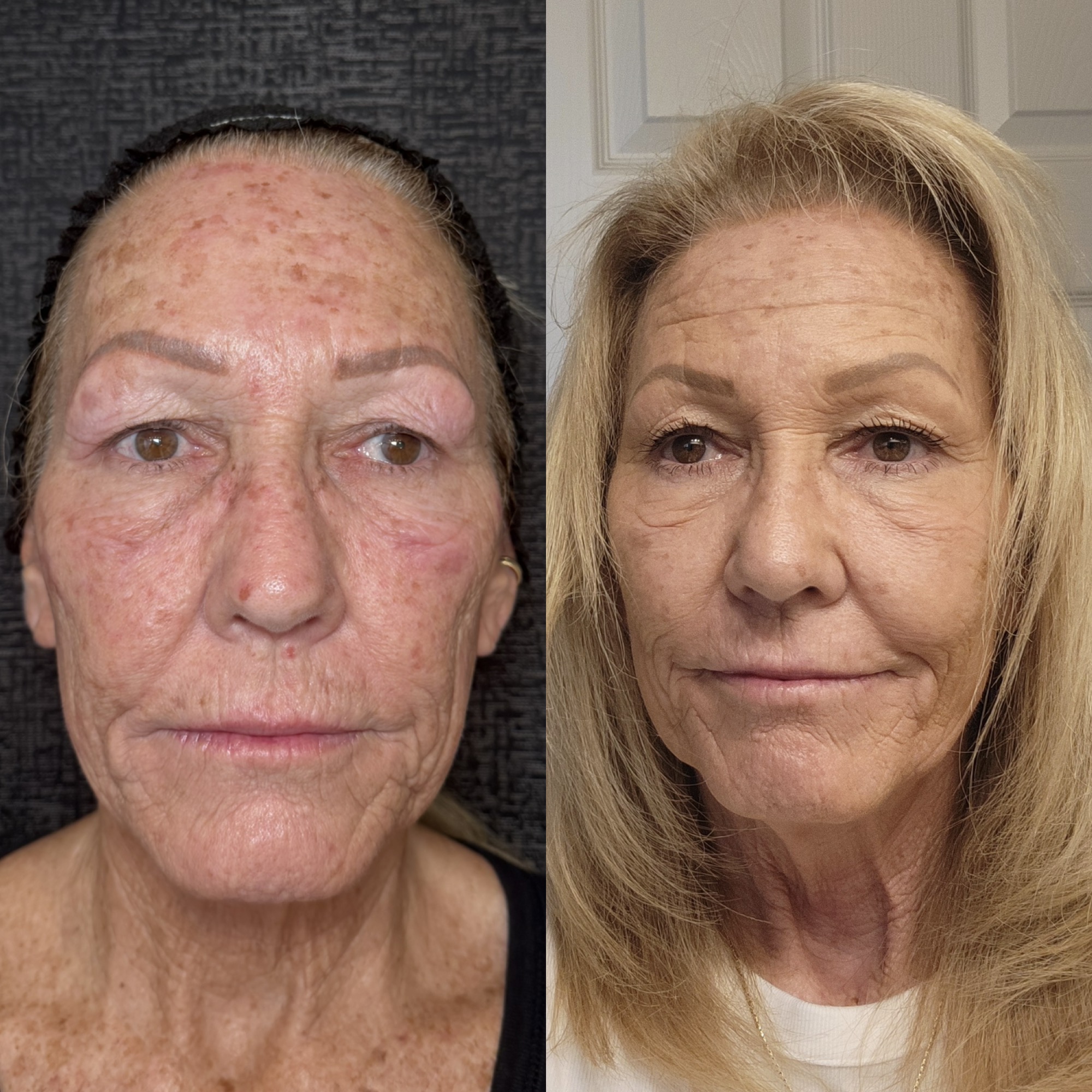 CO2 laser resurfacing before and after results — Clearwater FL