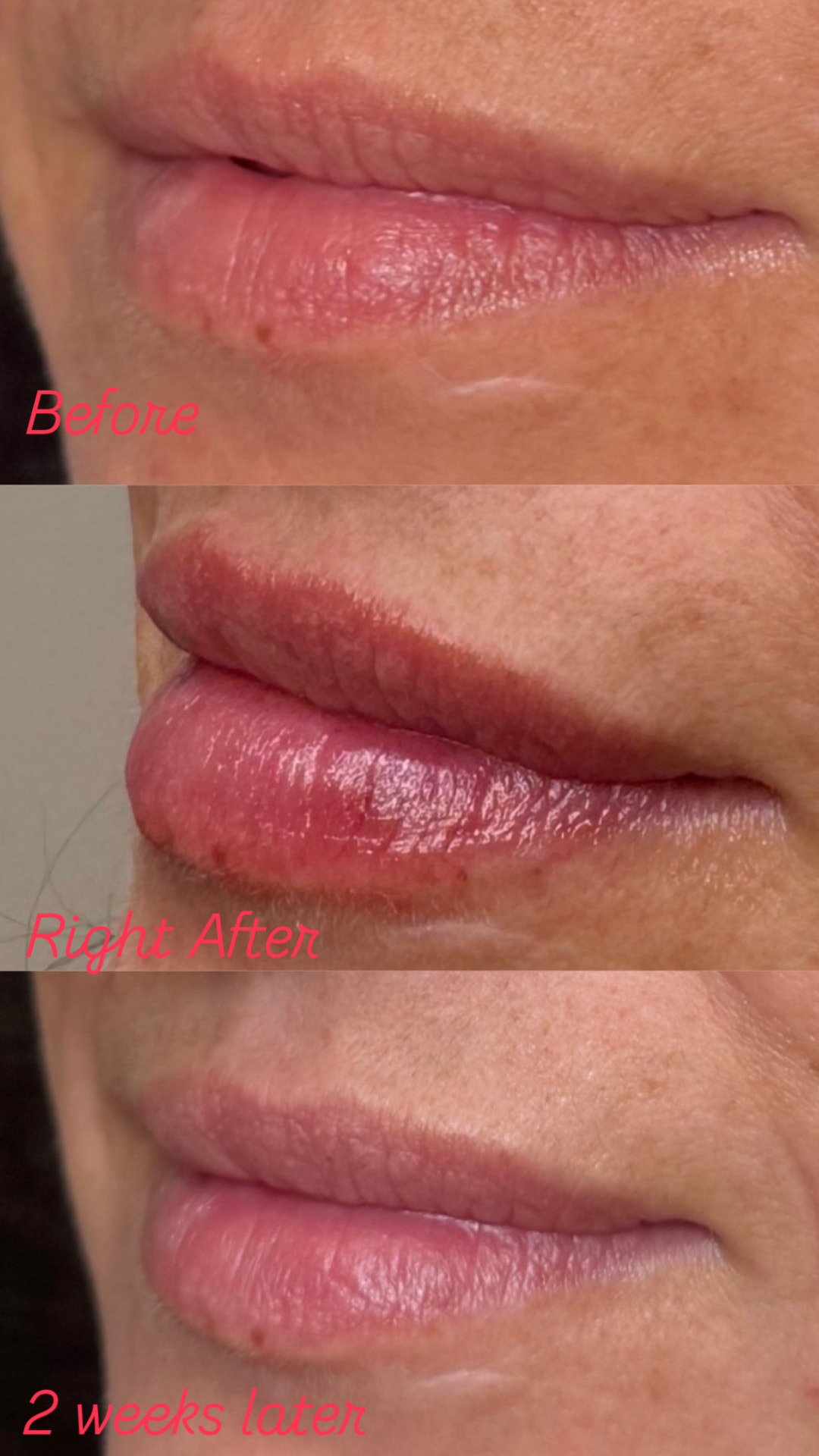 Lip filler before, right after and 2 weeks later — three-quarter view, Clearwater FL