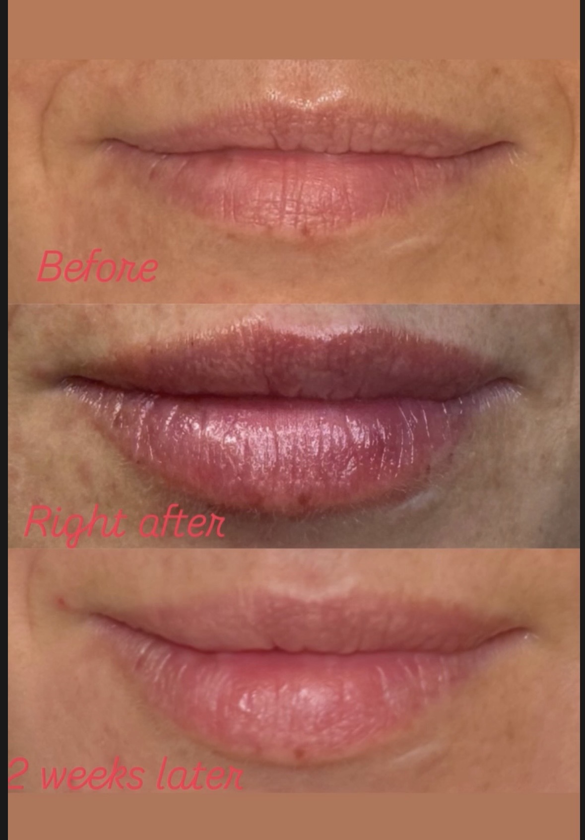 Lip filler before, right after and 2 weeks later — frontal view, Clearwater FL