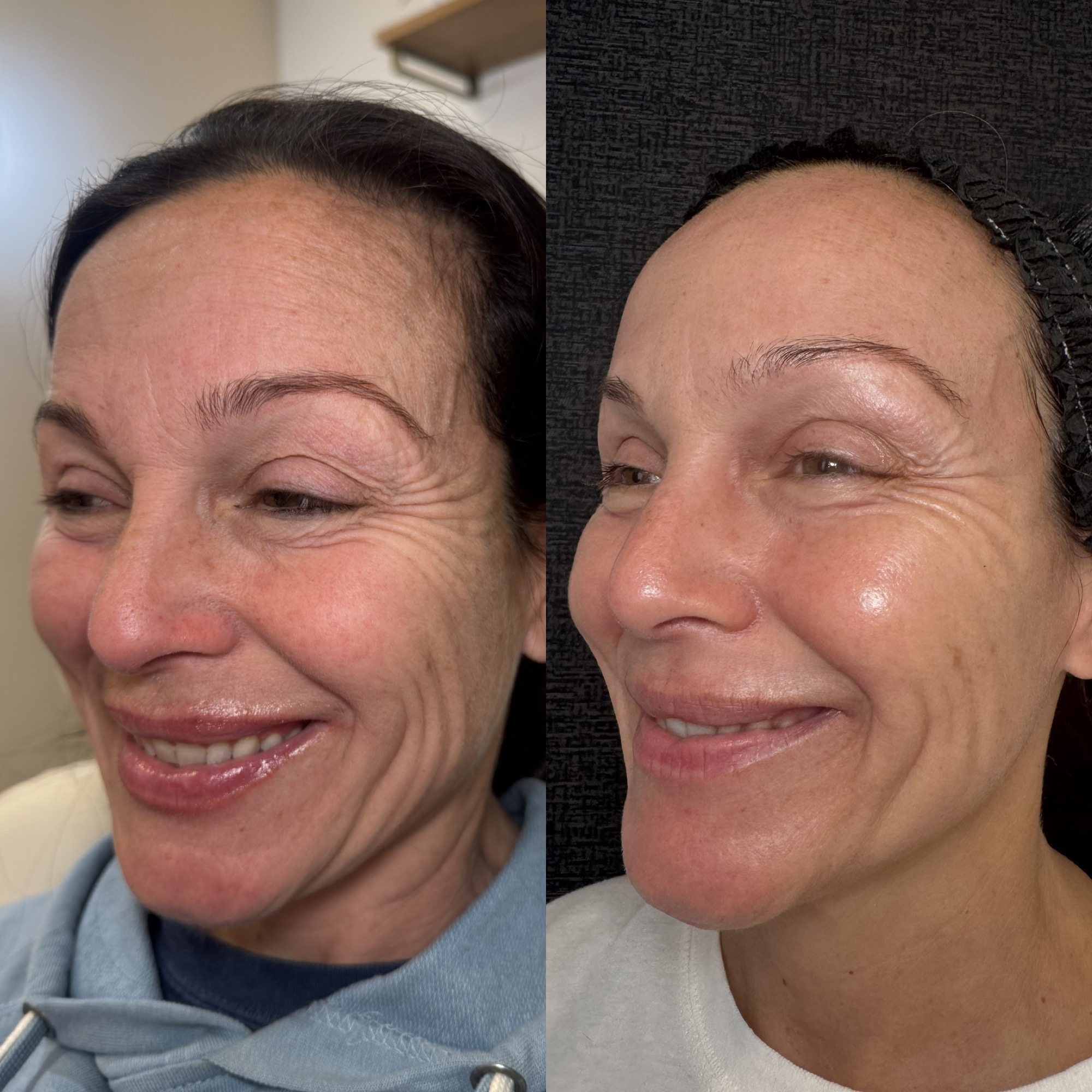 Before and after moderate to aggressive mixed-mode CO2 laser resurfacing — three-quarter view, Clearwater FL