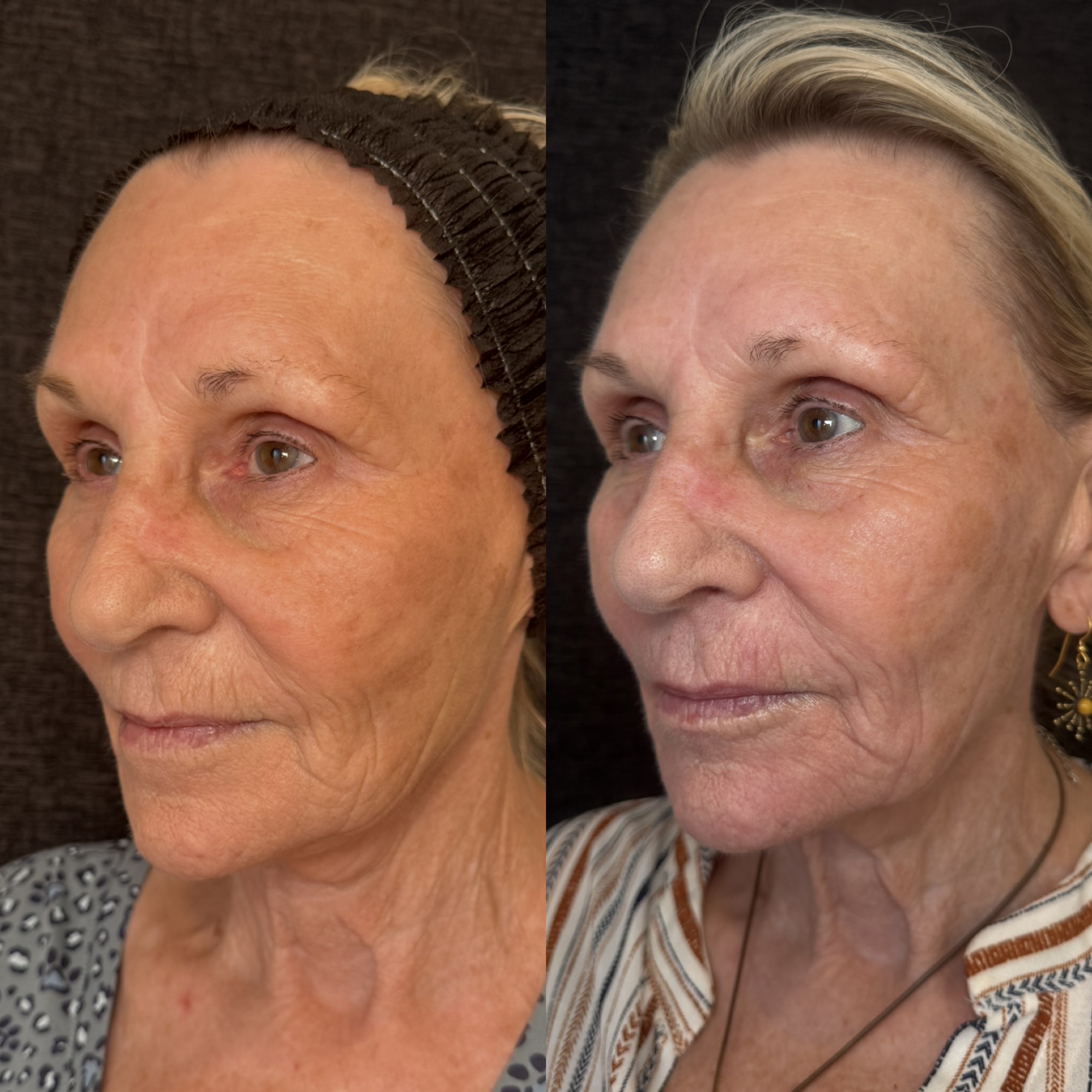 Right before and 2 weeks after aggressive mixed-mode CO2 laser resurfacing — left three-quarter view, Clearwater FL