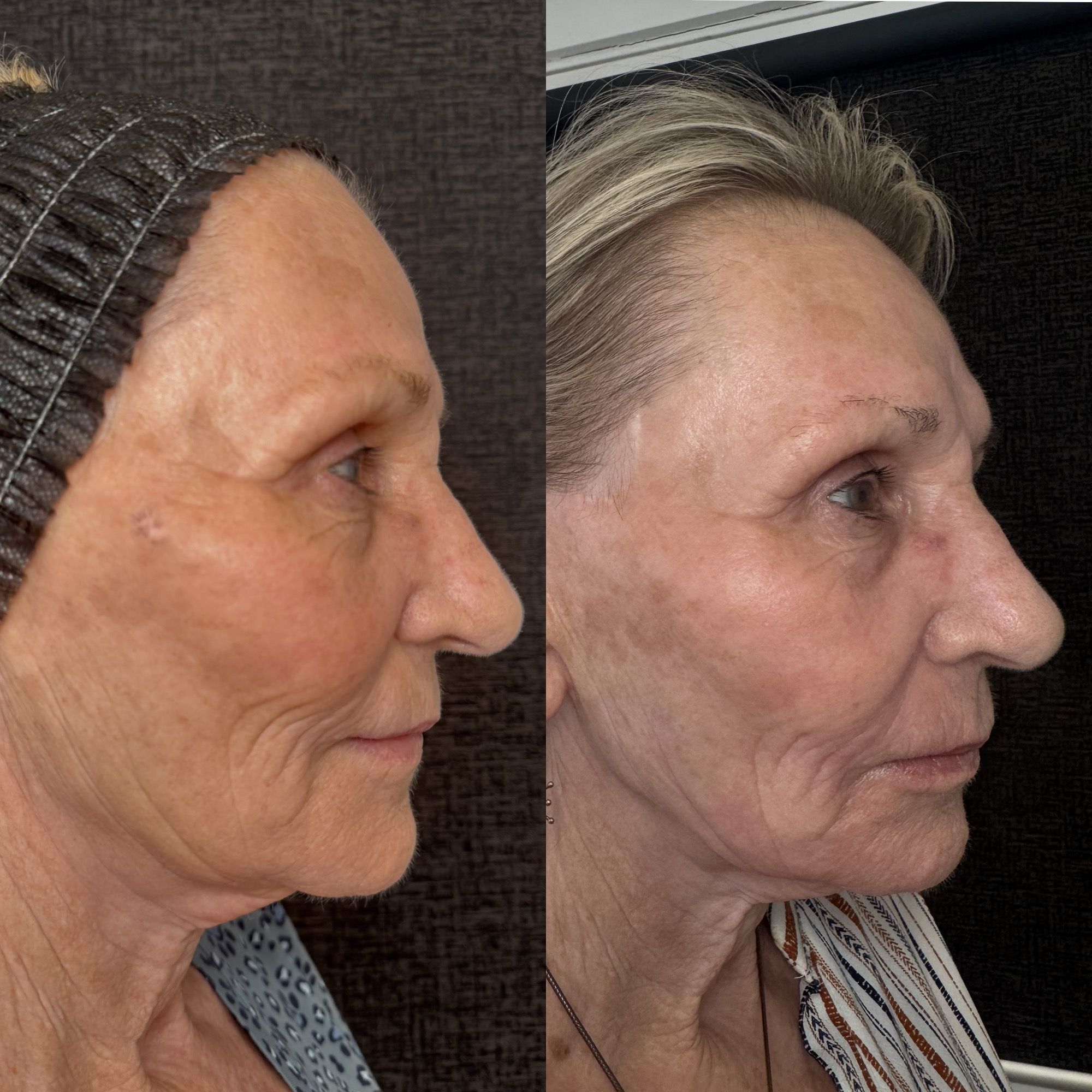 Right before and 2 weeks after aggressive mixed-mode CO2 laser resurfacing — right profile, Clearwater FL