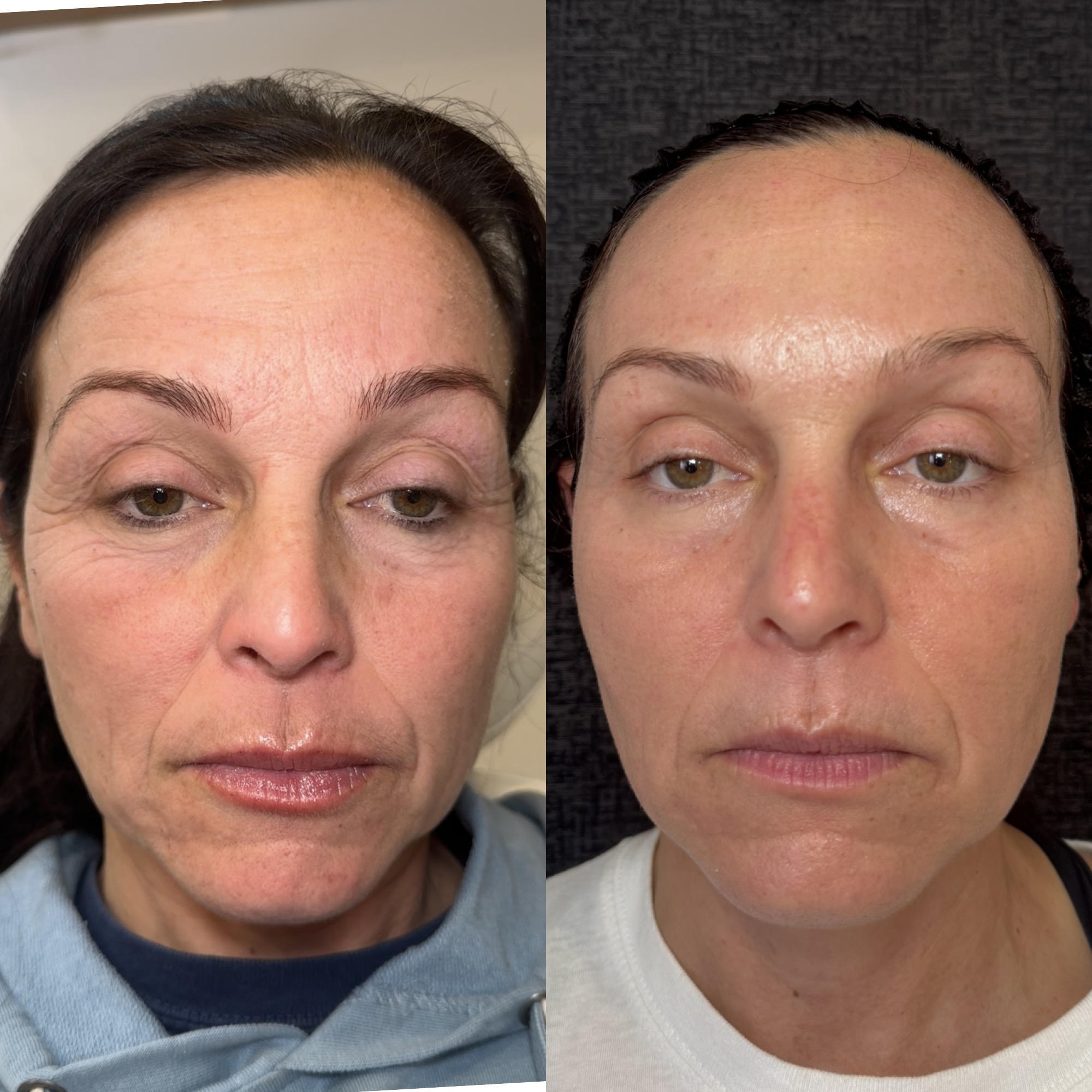 CO2 laser skin resurfacing before and after — Clearwater FL