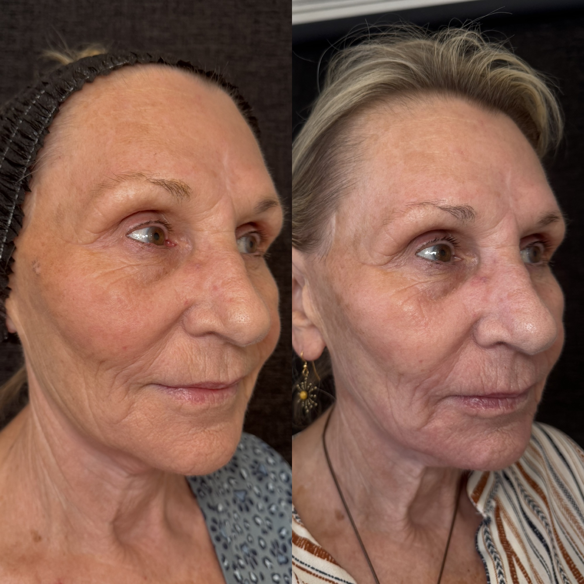 Right before and 2 weeks after aggressive mixed-mode CO2 laser resurfacing — right three-quarter view, Clearwater FL