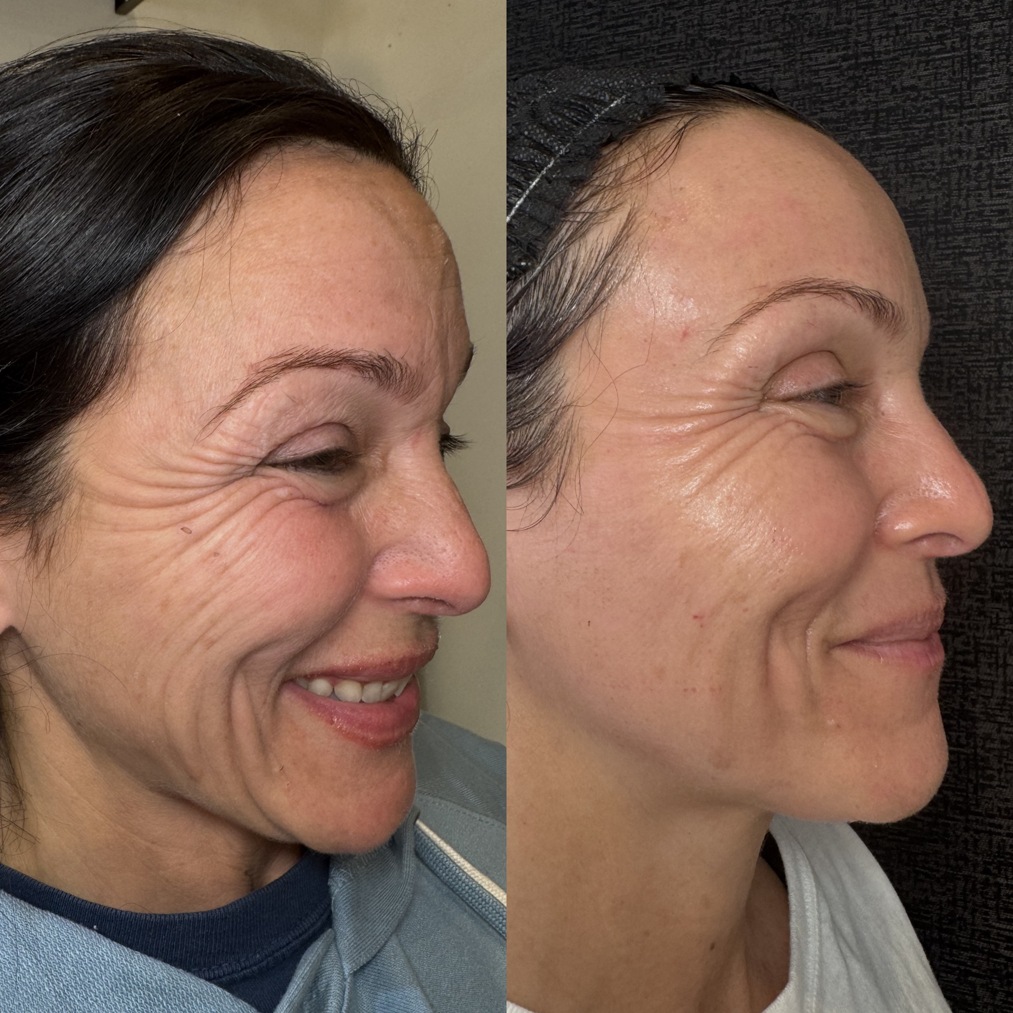 Before and after mixed-mode CO2 laser resurfacing — side profile, Clearwater FL