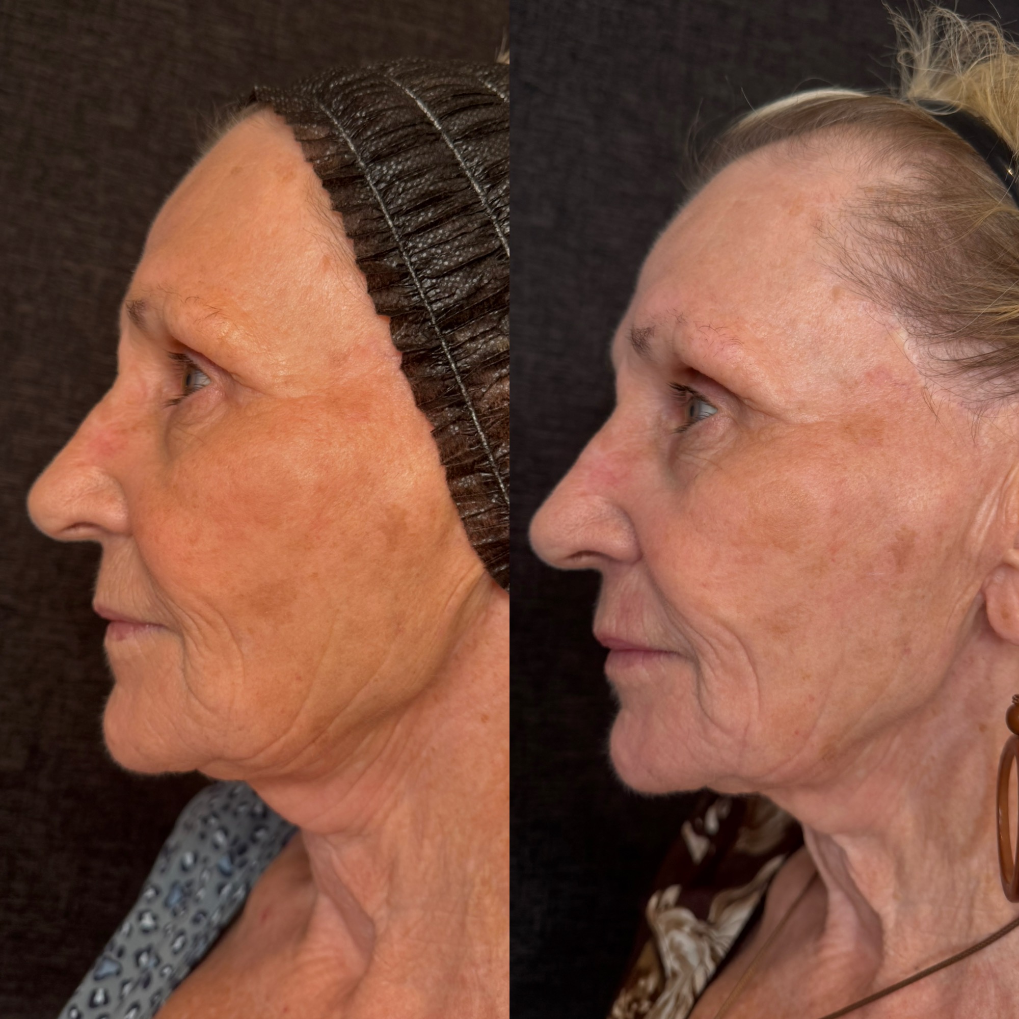 Right before and 2 weeks after aggressive mixed-mode CO2 laser resurfacing — left profile, Clearwater FL