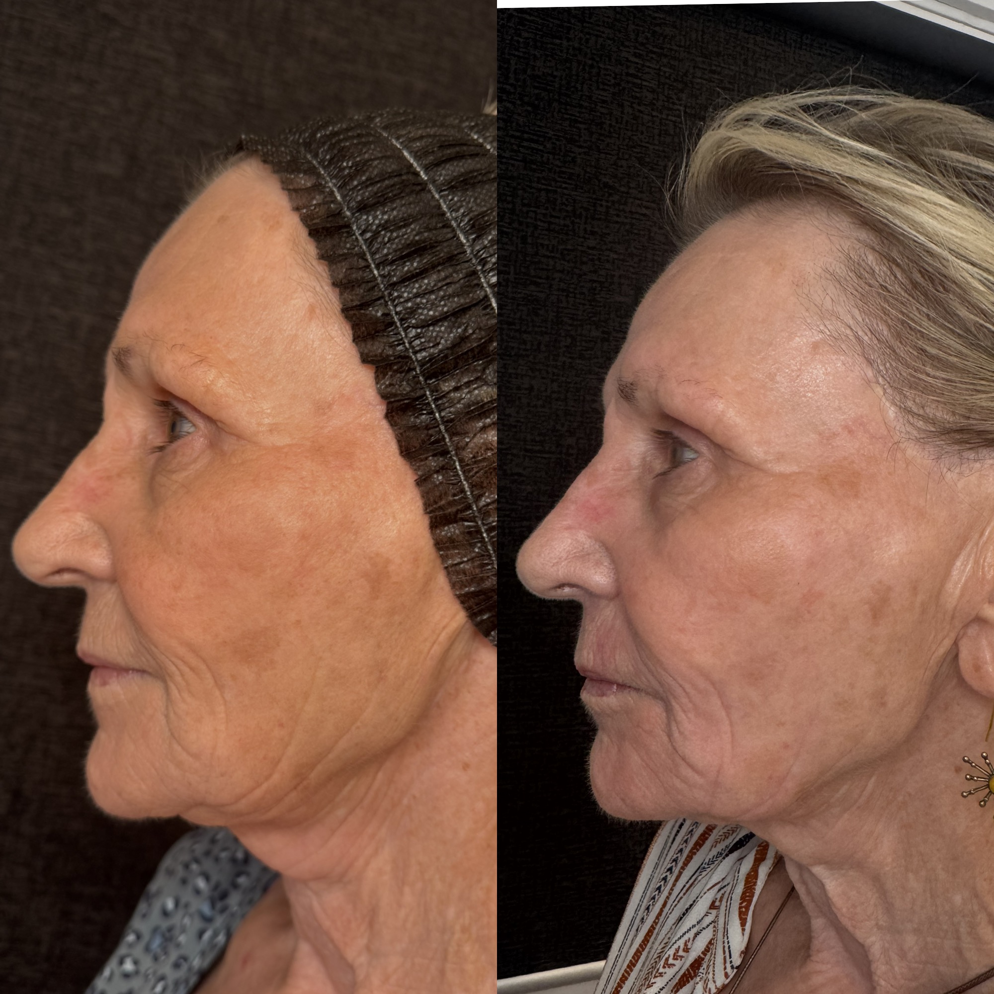 Right before and 2 weeks after aggressive mixed-mode CO2 laser resurfacing — left profile, Clearwater FL