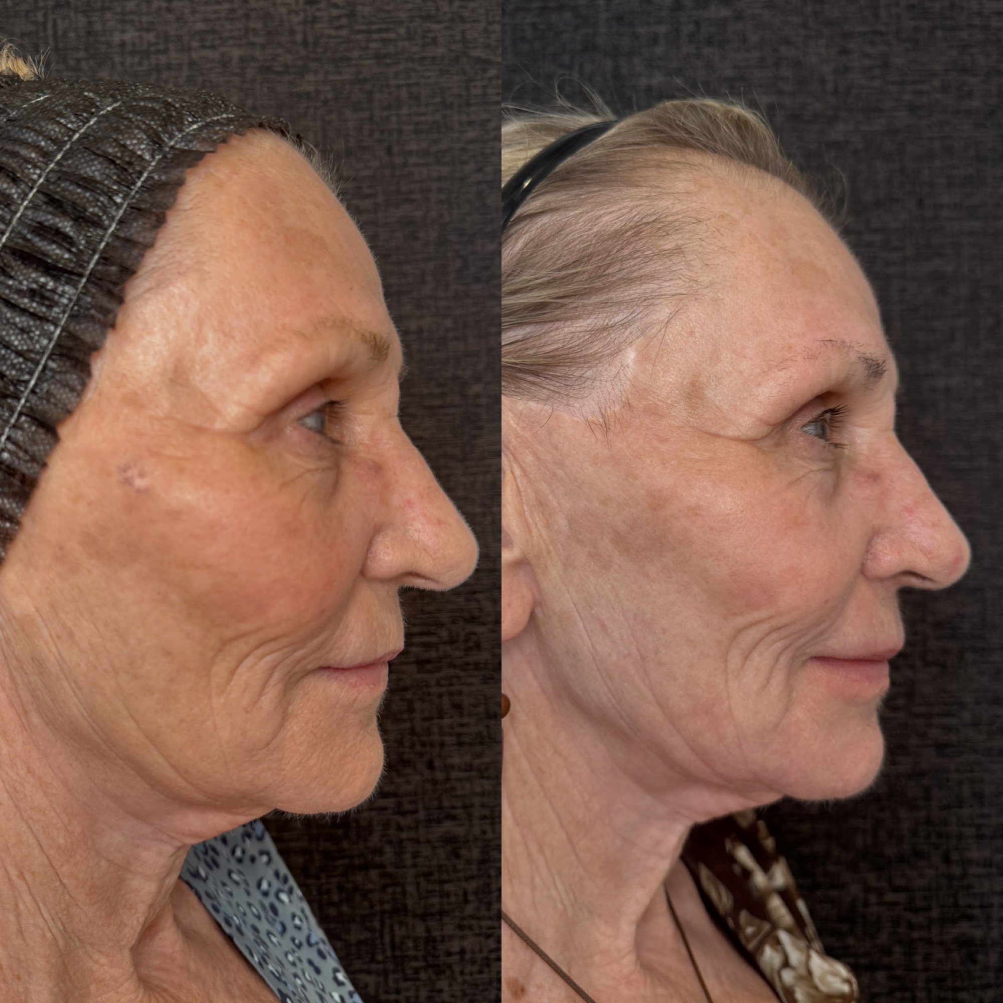 Right before and 2 weeks after aggressive mixed-mode CO2 laser resurfacing — right profile, Clearwater FL