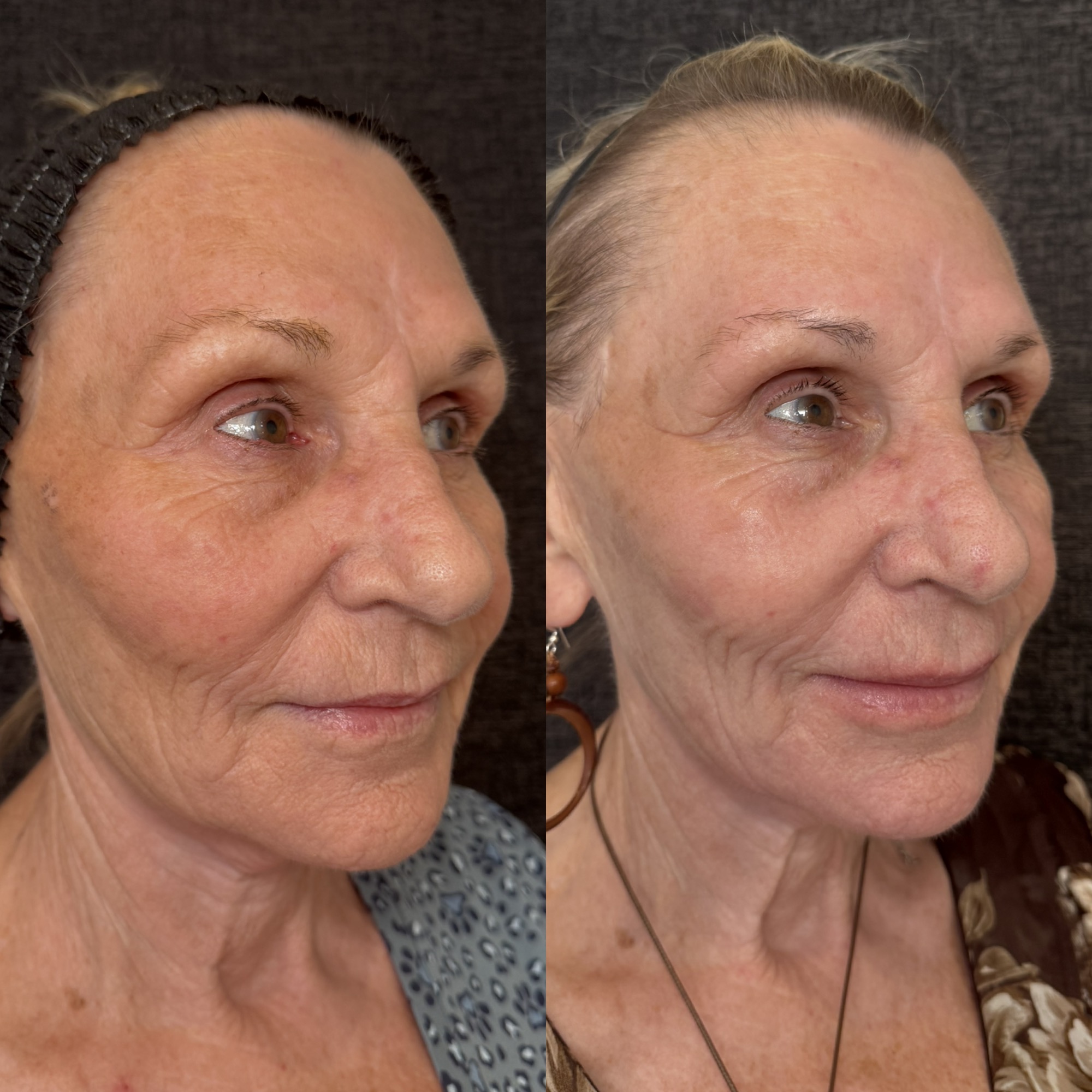 Right before and 2 weeks after aggressive mixed-mode CO2 laser resurfacing — right three-quarter view, Clearwater FL