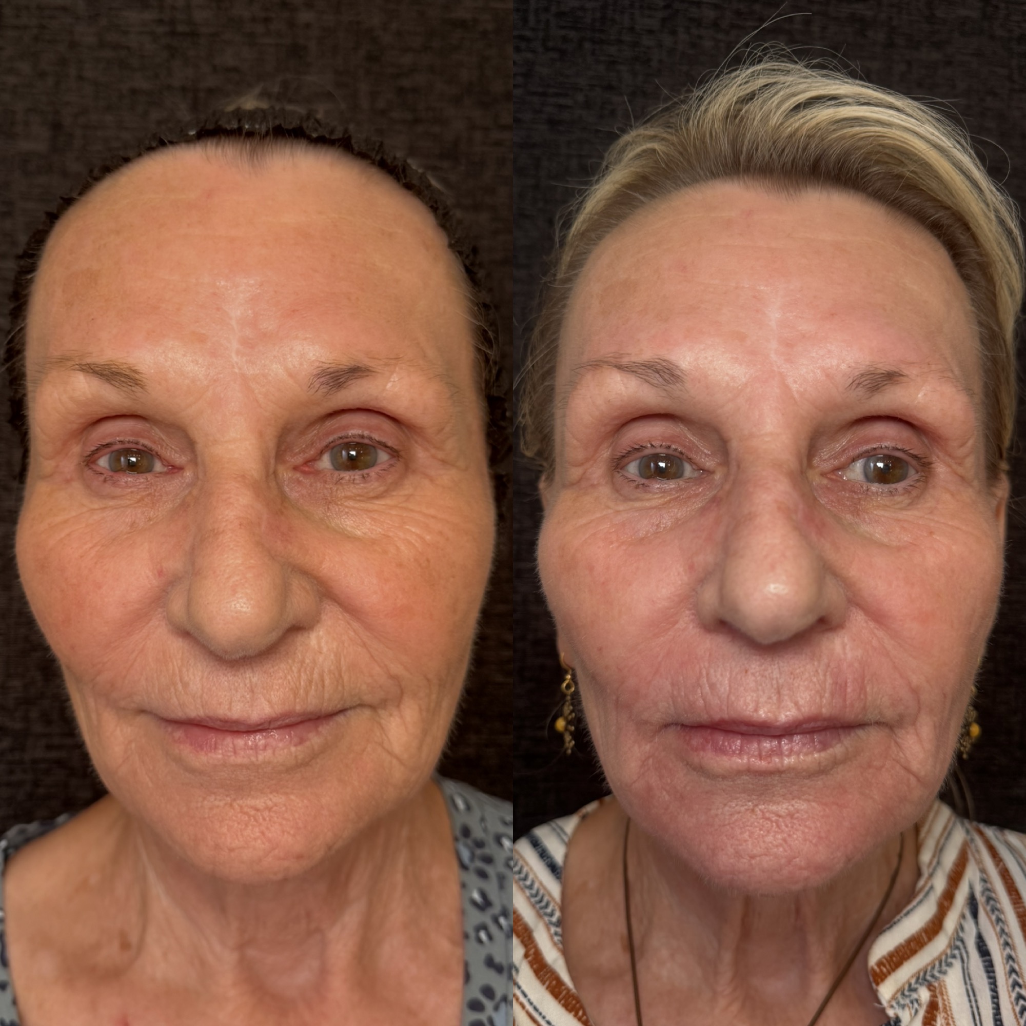 Right before and 2 weeks after aggressive mixed-mode CO2 laser resurfacing — frontal view, Clearwater FL