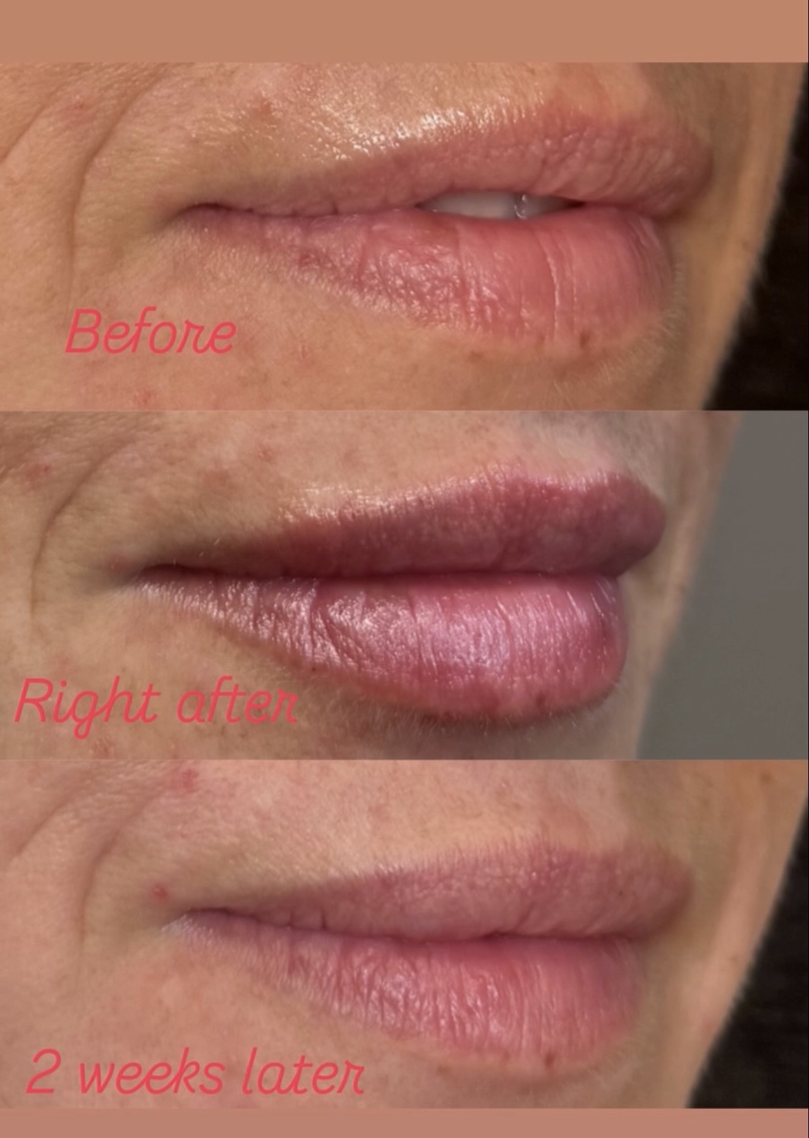 Lip filler before, right after and 2 weeks later — three-quarter view from the other side, Clearwater FL