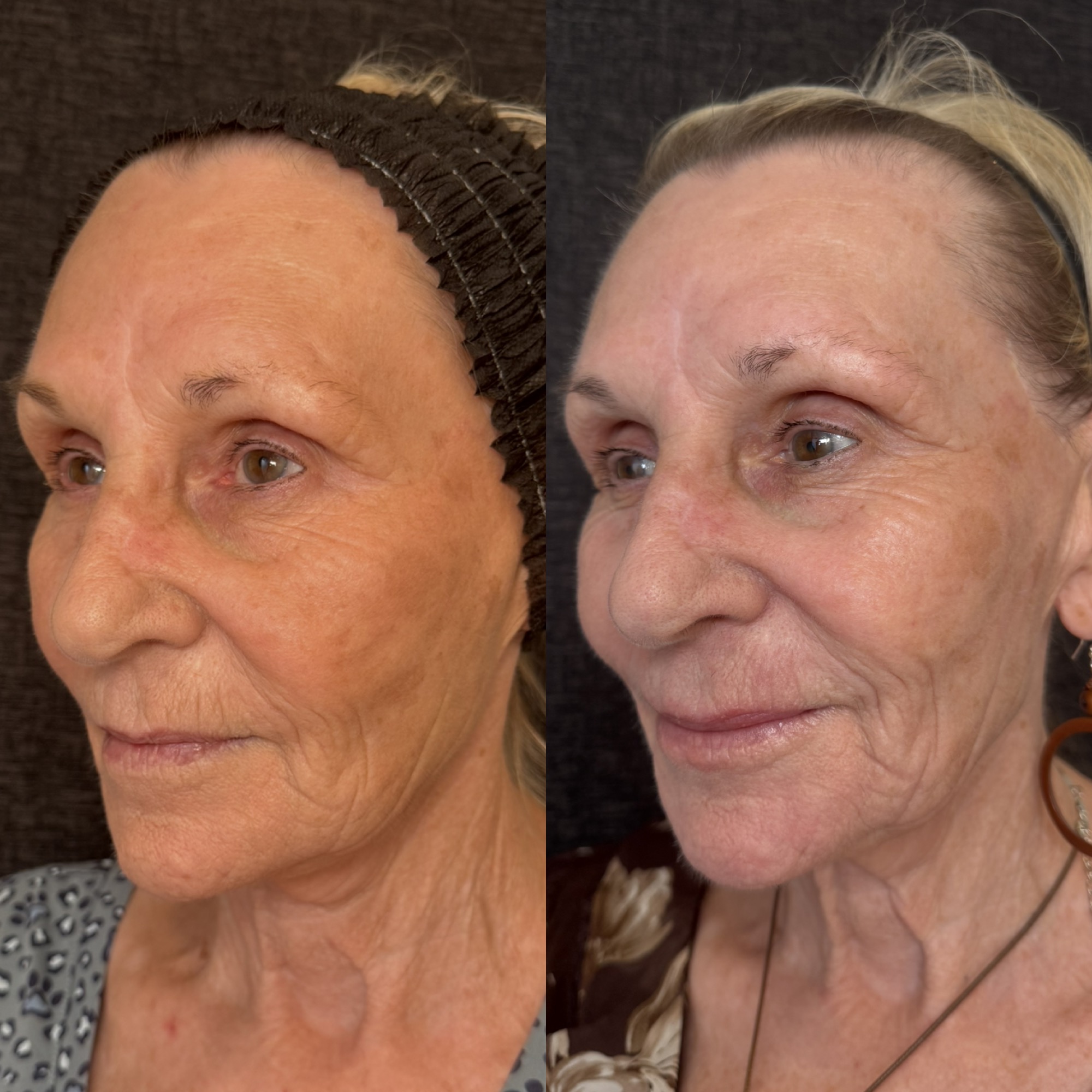 Right before and 2 weeks after aggressive mixed-mode CO2 laser resurfacing — left three-quarter view, Clearwater FL