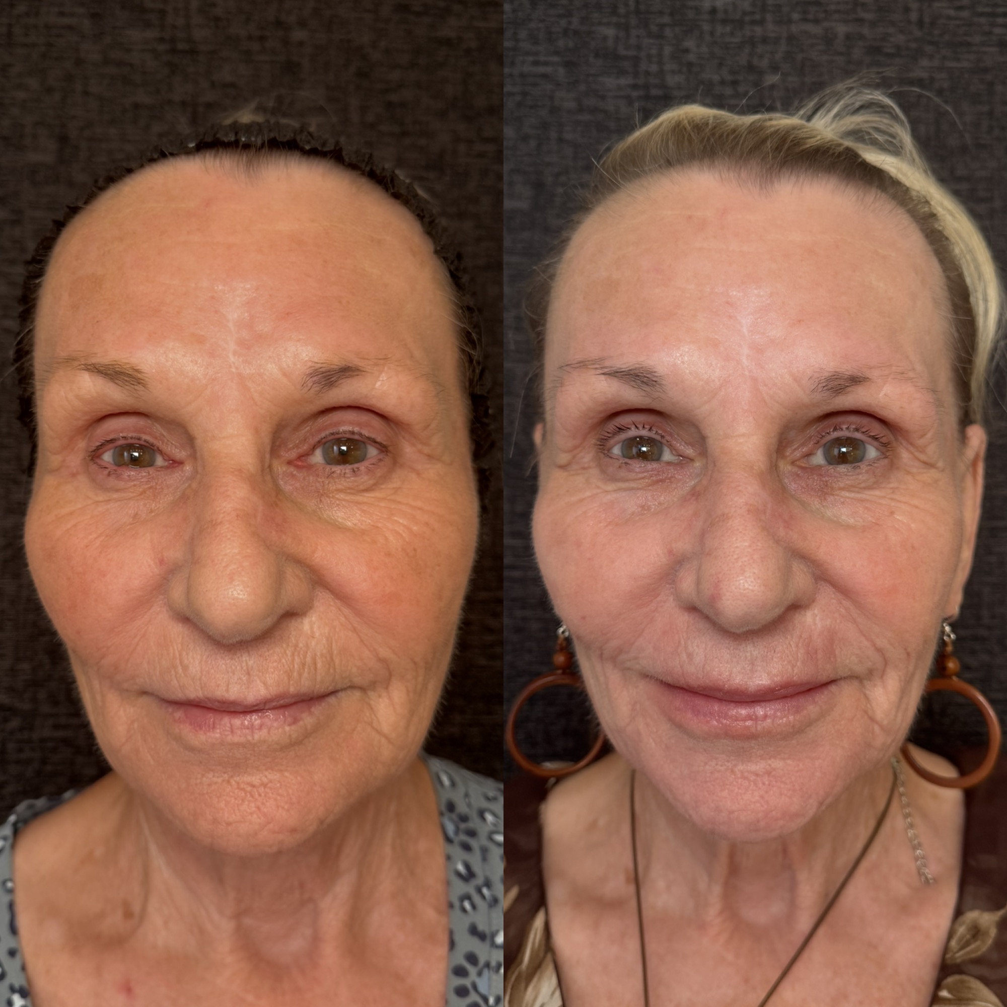Right before and 2 weeks after aggressive mixed-mode CO2 laser resurfacing — frontal view, Clearwater FL