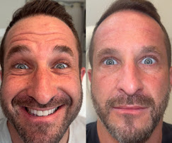 Botox before and after — natural results, Clearwater FL