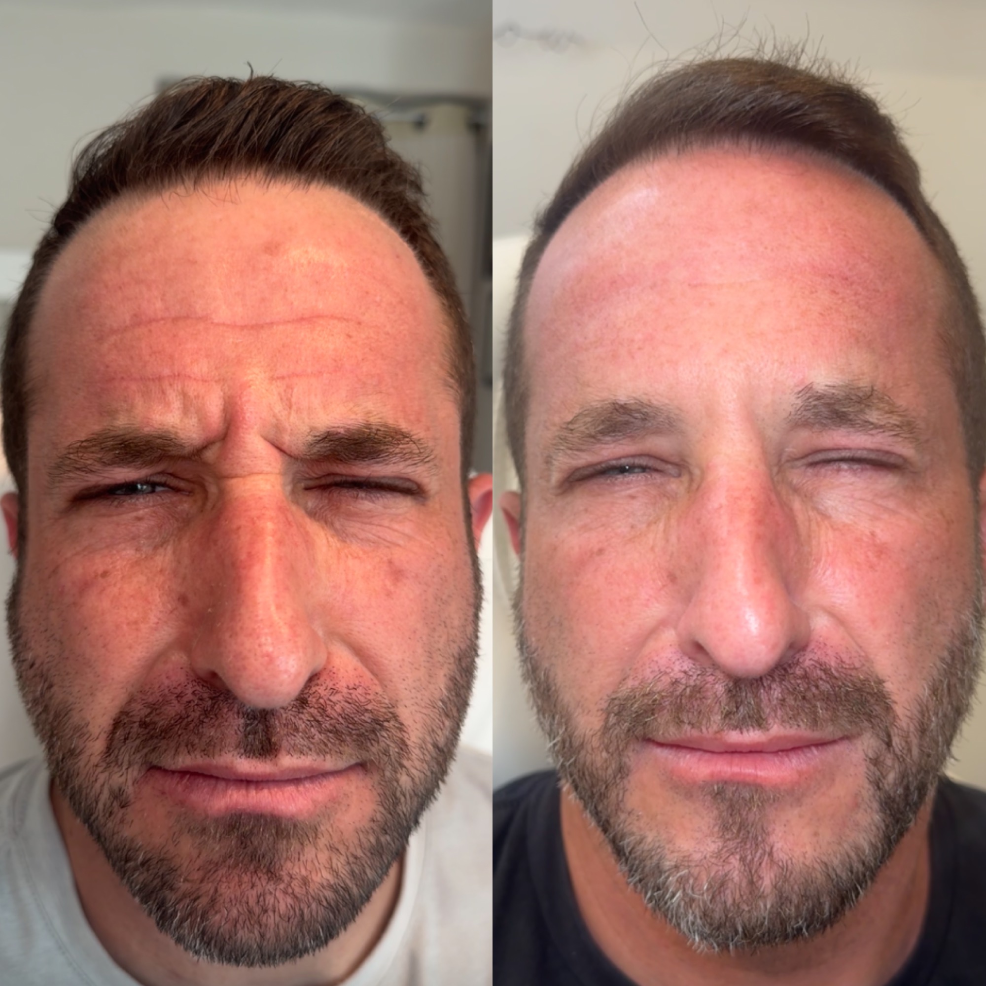 Botox · Forehead & 11s before and after at Eternal Beauty Lifestyle Clearwater Spa