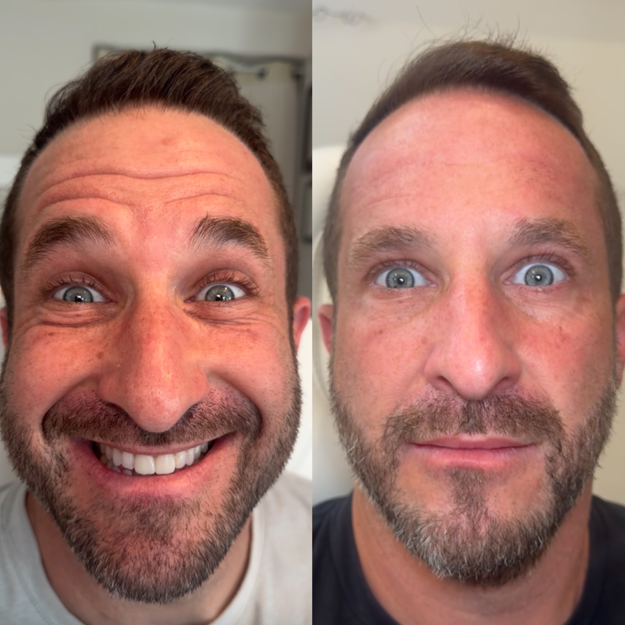 Botox · Glabellar Lines before and after at Eternal Beauty Lifestyle Clearwater Spa