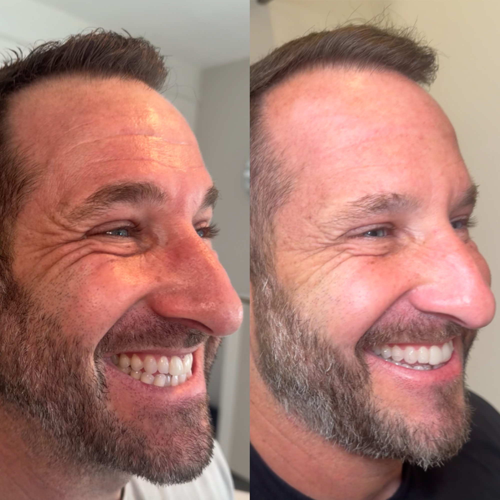 Botox for men before and after — Clearwater FL