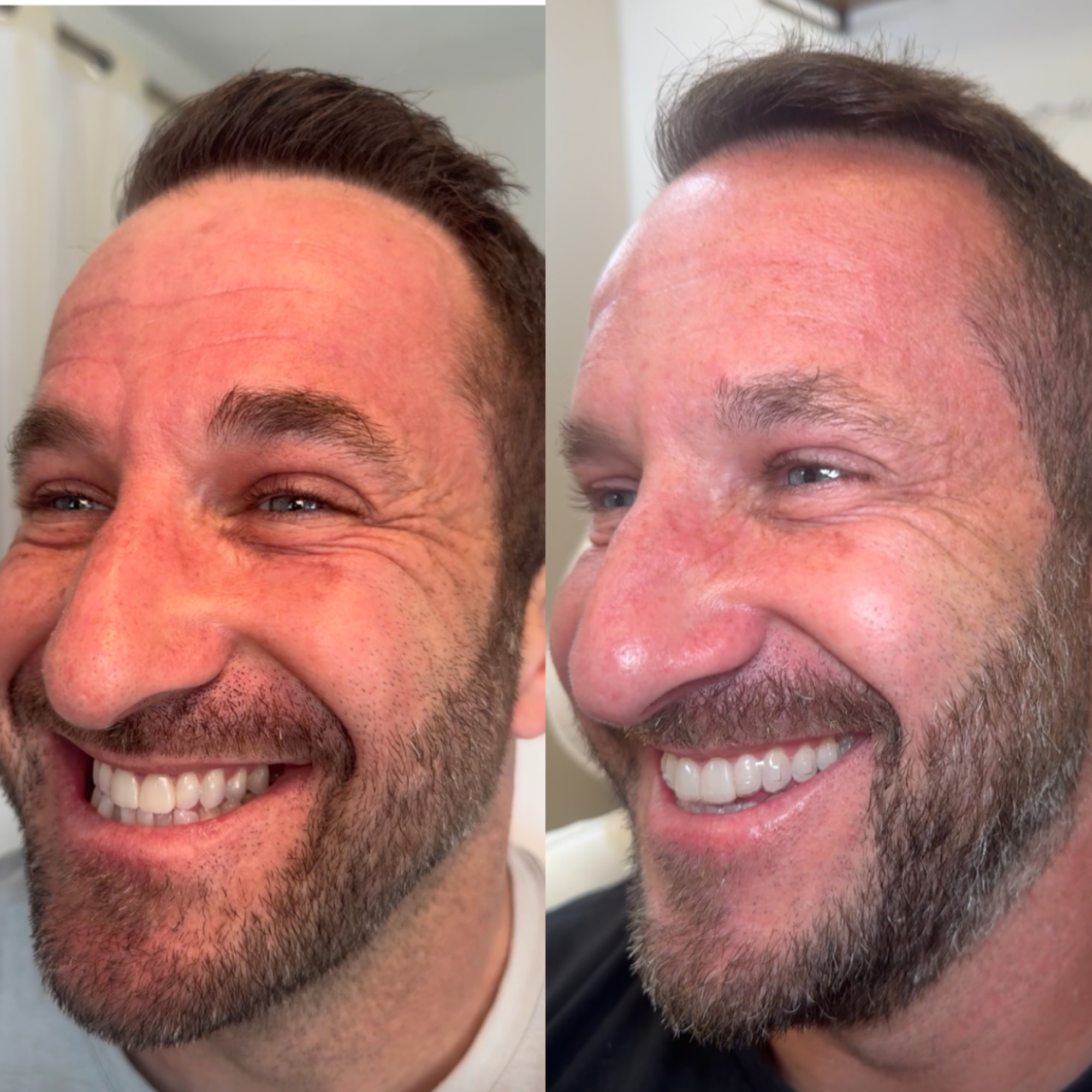 Botox for men before and after — Clearwater FL