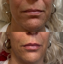 Chin & Lip Contouring before and after at Eternal Beauty Lifestyle Clearwater Spa