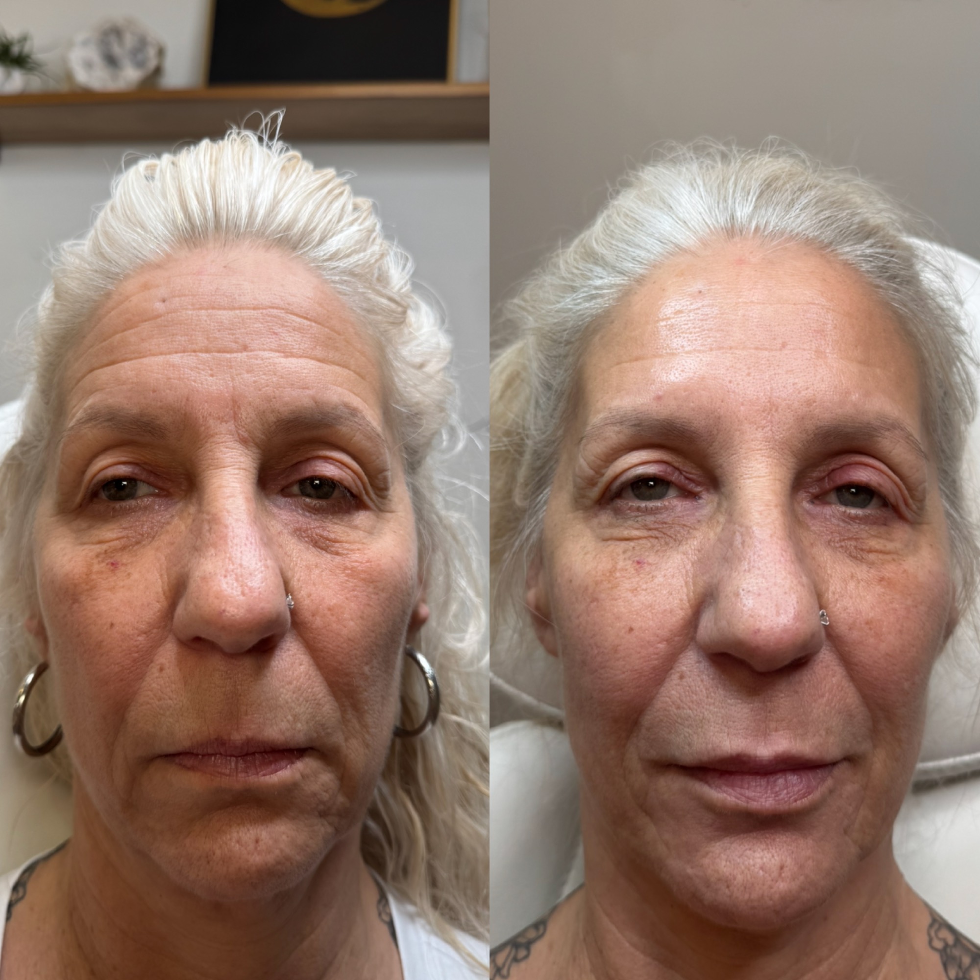Daxxify / Botox before and after — forehead & smile lines smoothed, Clearwater FL