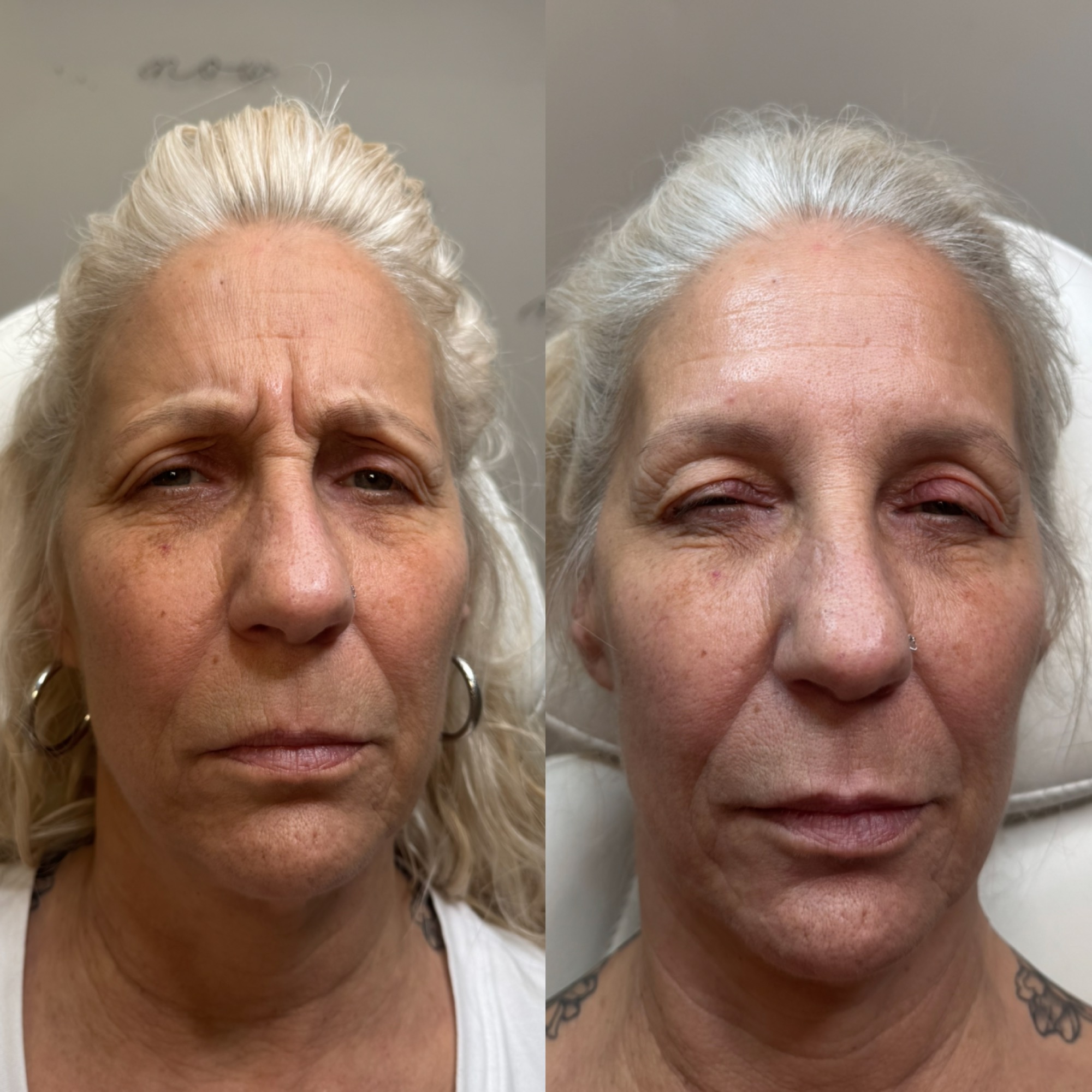 Daxxify / Botox before and after — 11s and frown lines relaxed, Clearwater FL