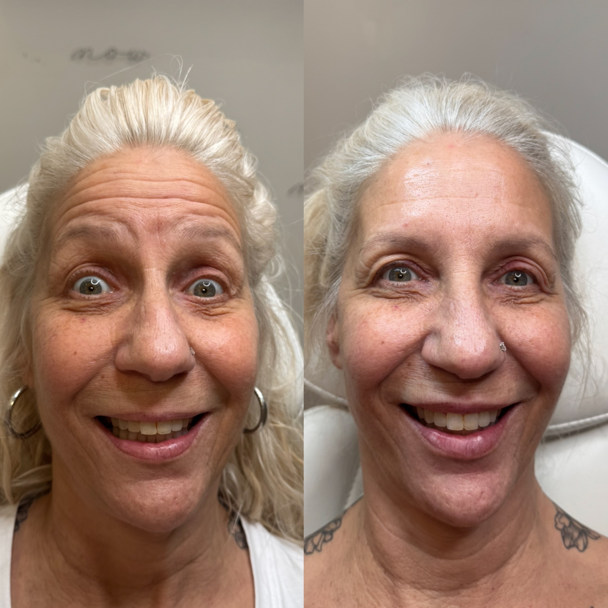 Daxxify / Botox before and after — animated forehead smoothed, Clearwater FL