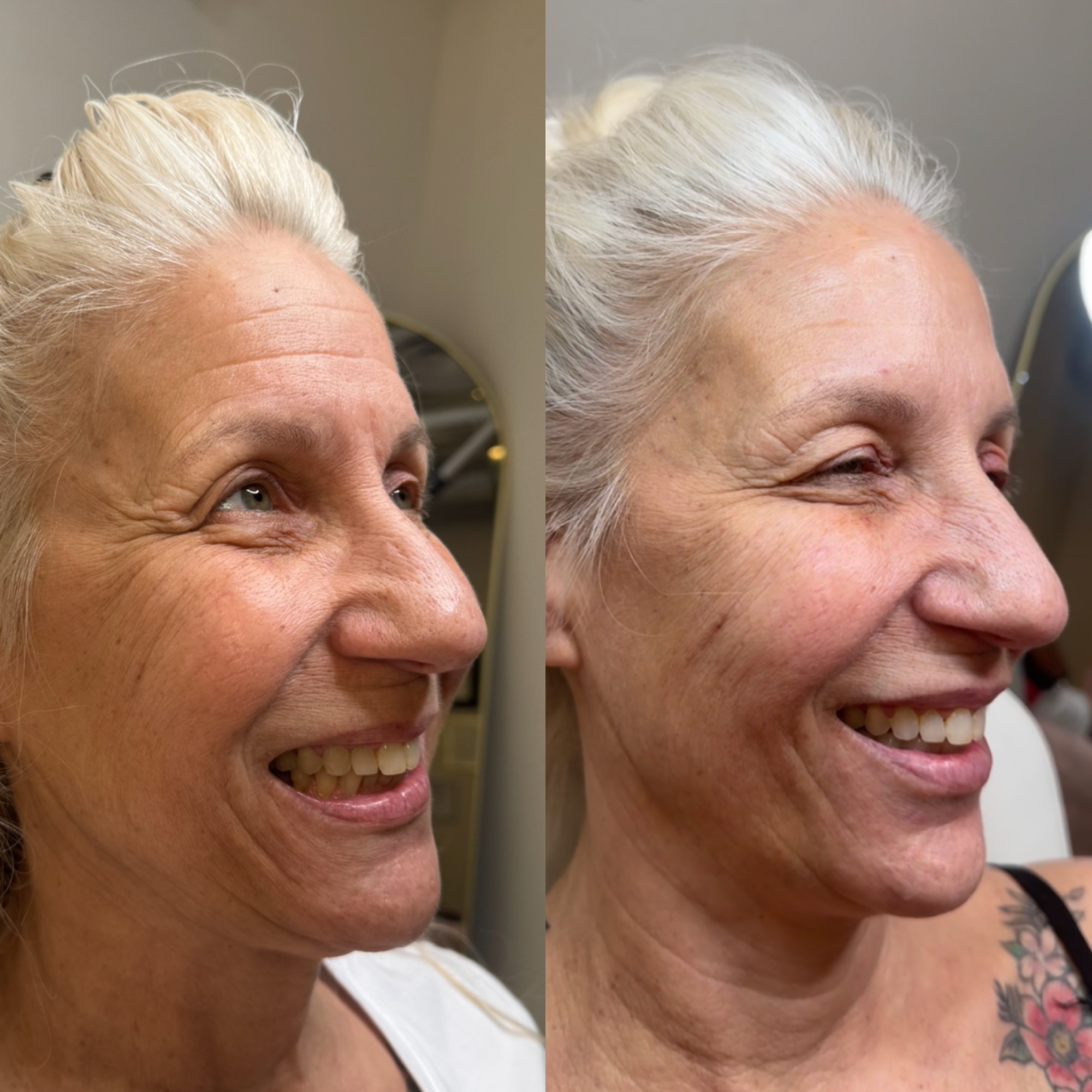 Daxxify / Botox before and after — side profile crow's feet softened, Clearwater FL