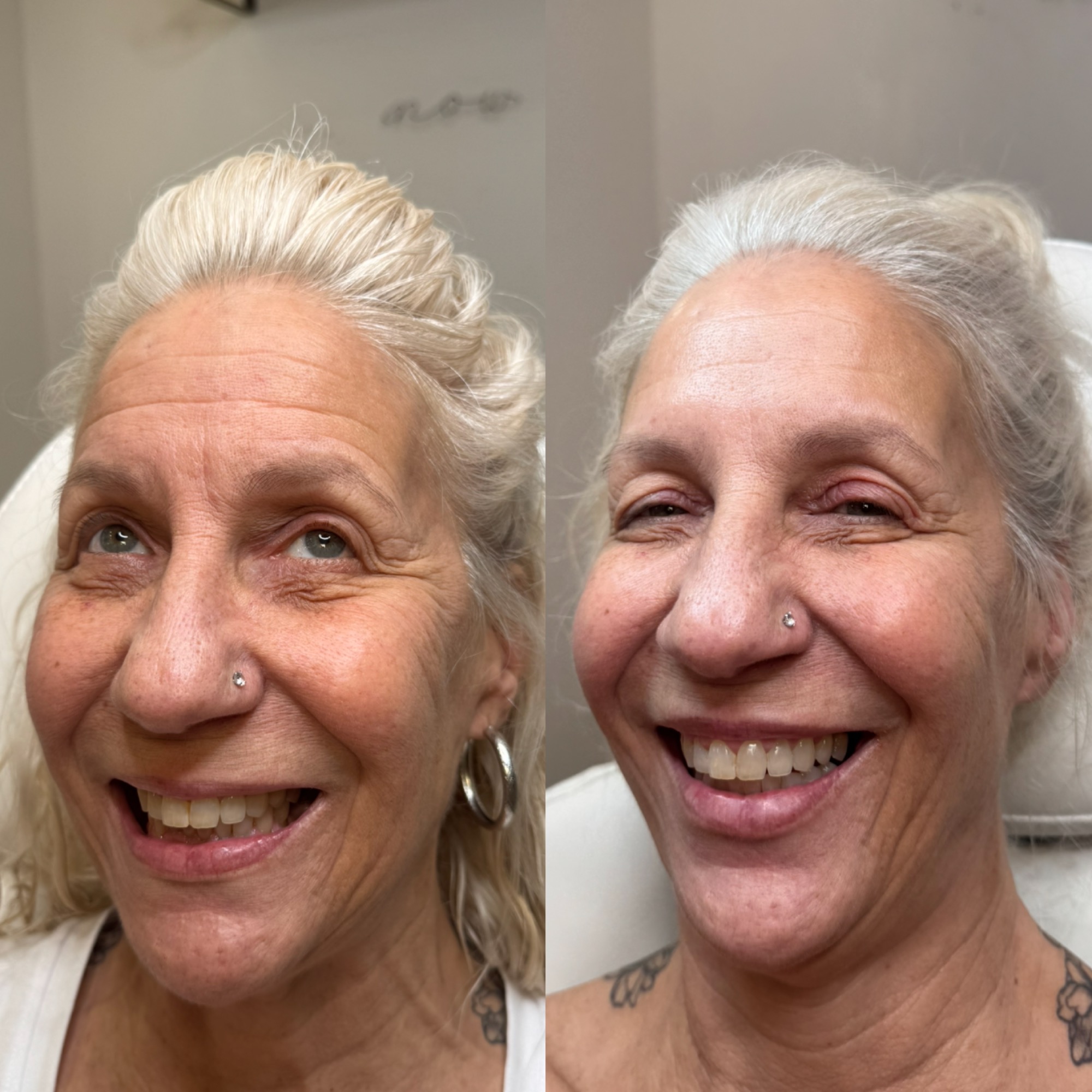 Daxxify / Botox before and after — refreshed natural smile, Clearwater FL