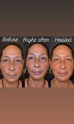 Filler · Healing Progression before and after at Eternal Beauty Lifestyle Clearwater Spa