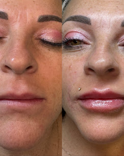 Full Face Refresh before and after at Eternal Beauty Lifestyle Clearwater Spa