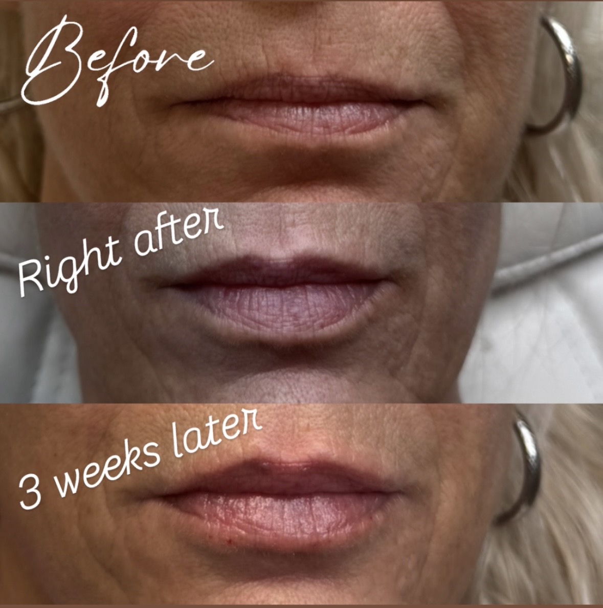 Lip Filler · Before / After / Healed before and after at Eternal Beauty Lifestyle Clearwater Spa