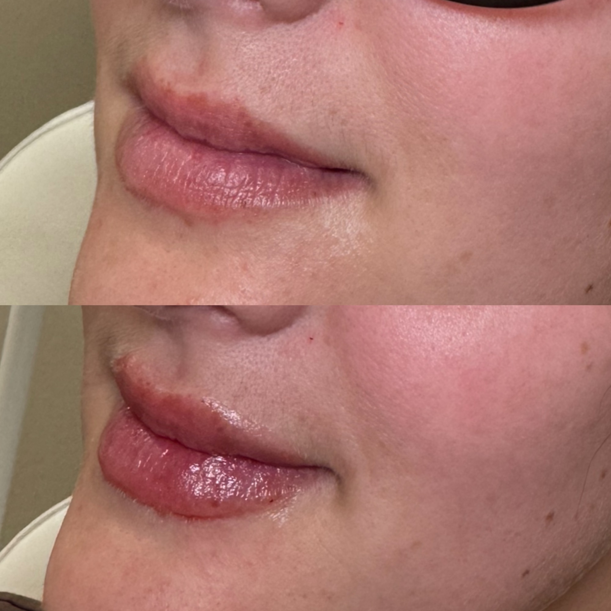 Lip filler before and after — side angle volume, Clearwater FL