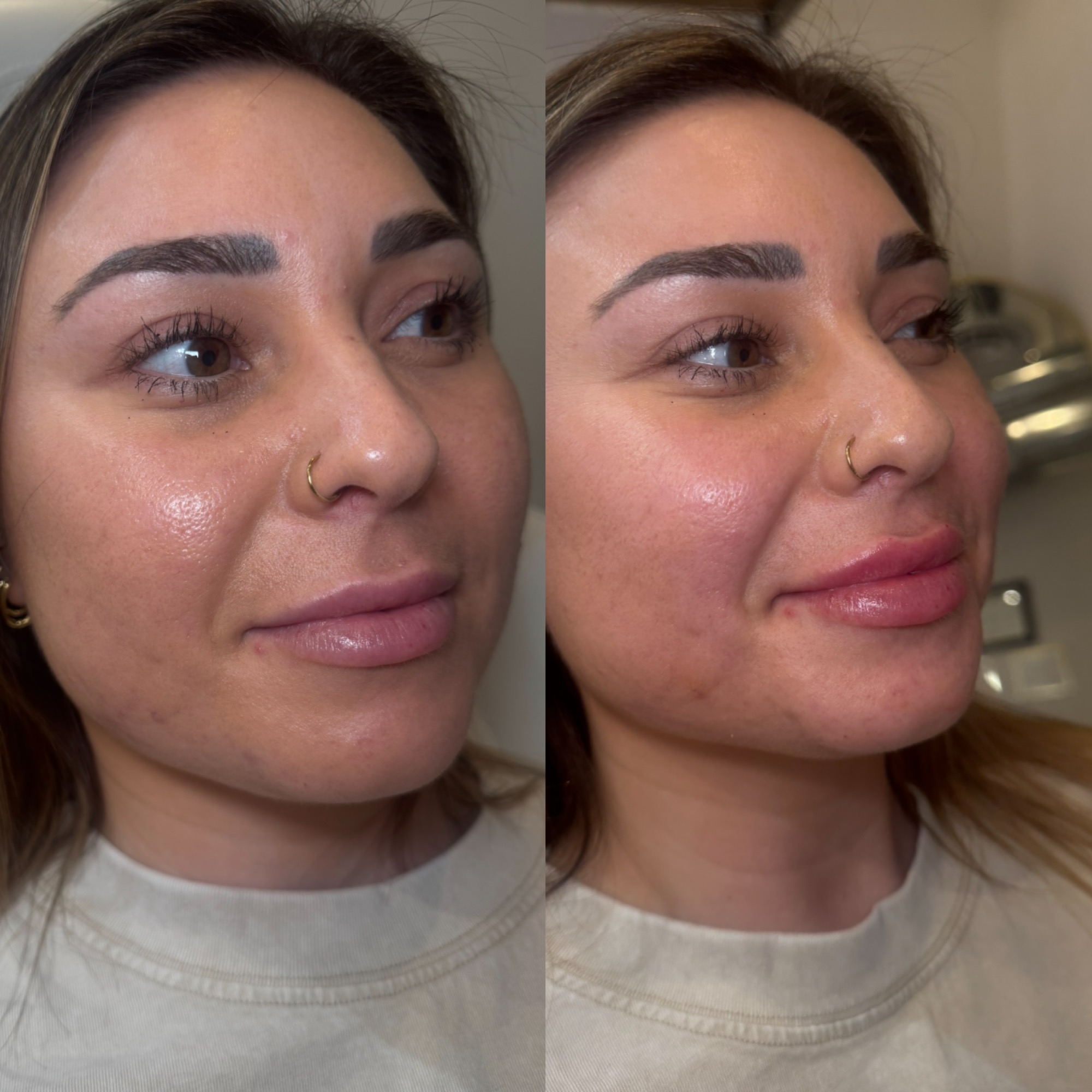 Lip filler before and after — three-quarter view, Clearwater FL