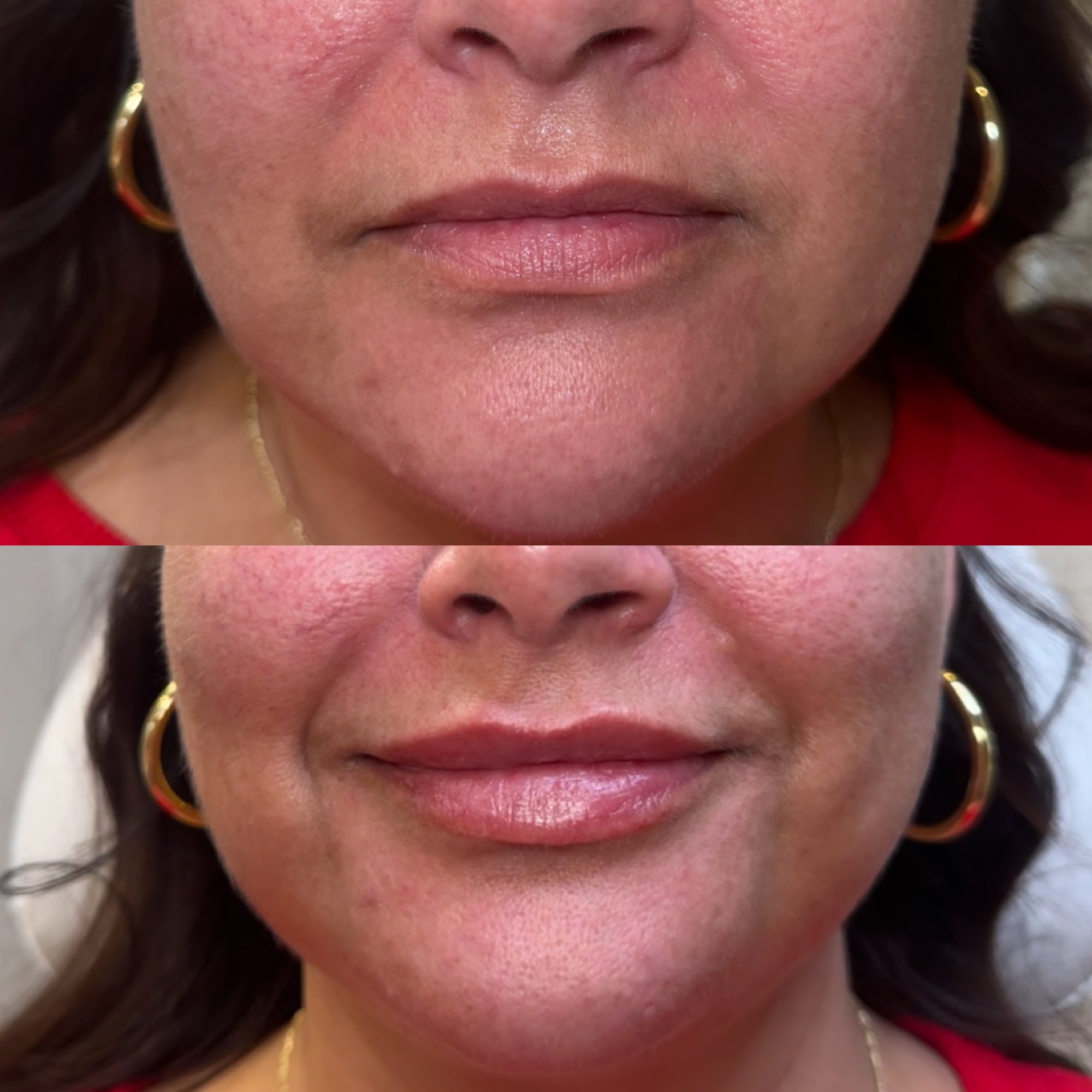Lip filler before and after — defined cupid's bow, Clearwater FL