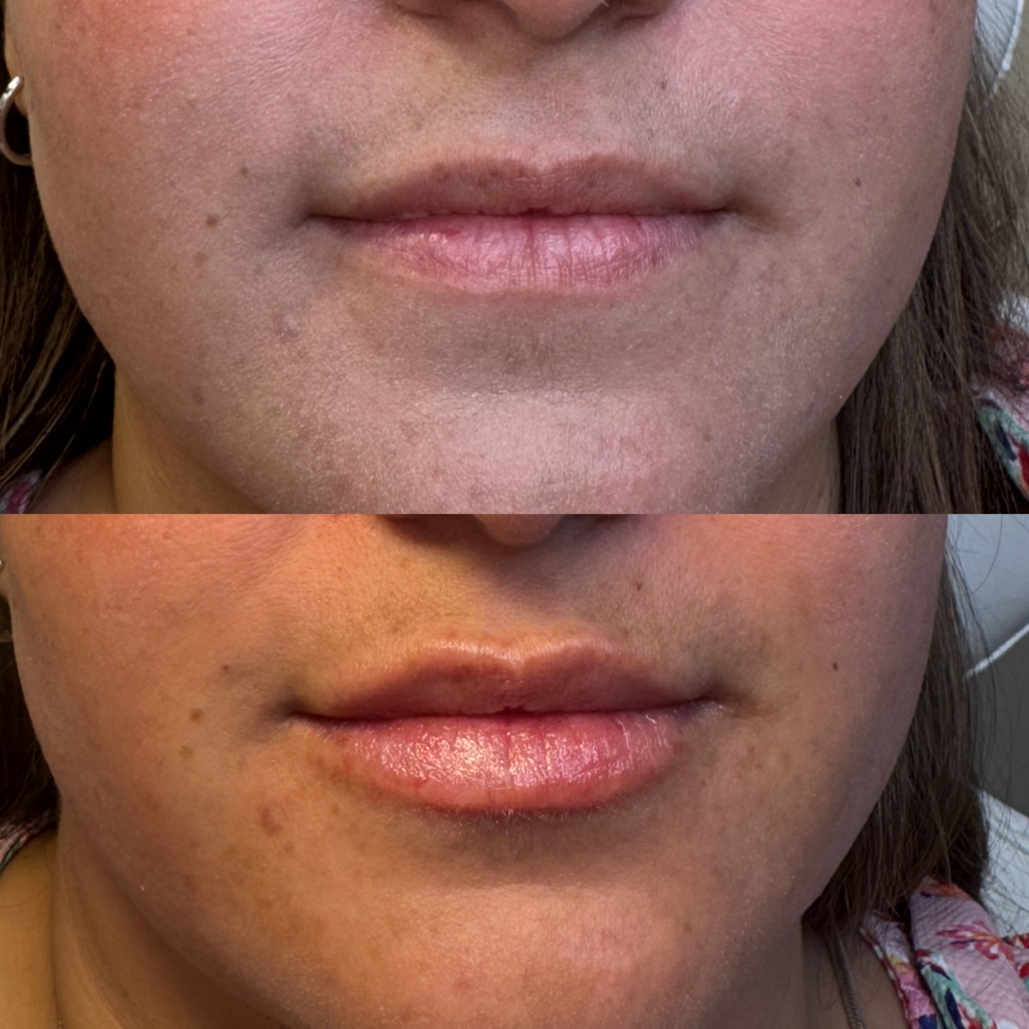 Lip filler before and after — added volume, Clearwater FL