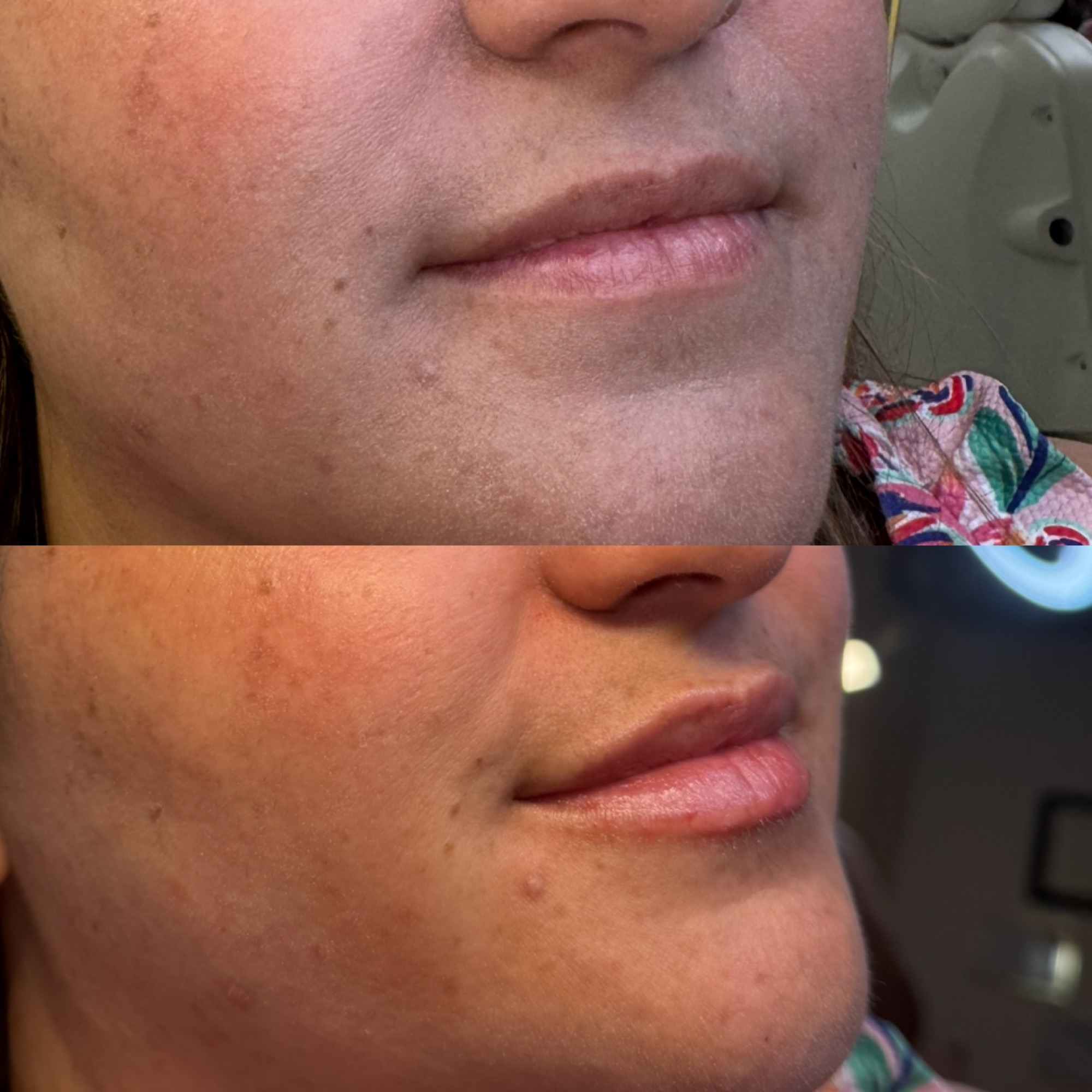 Lip filler before and after — refined shape, Clearwater FL