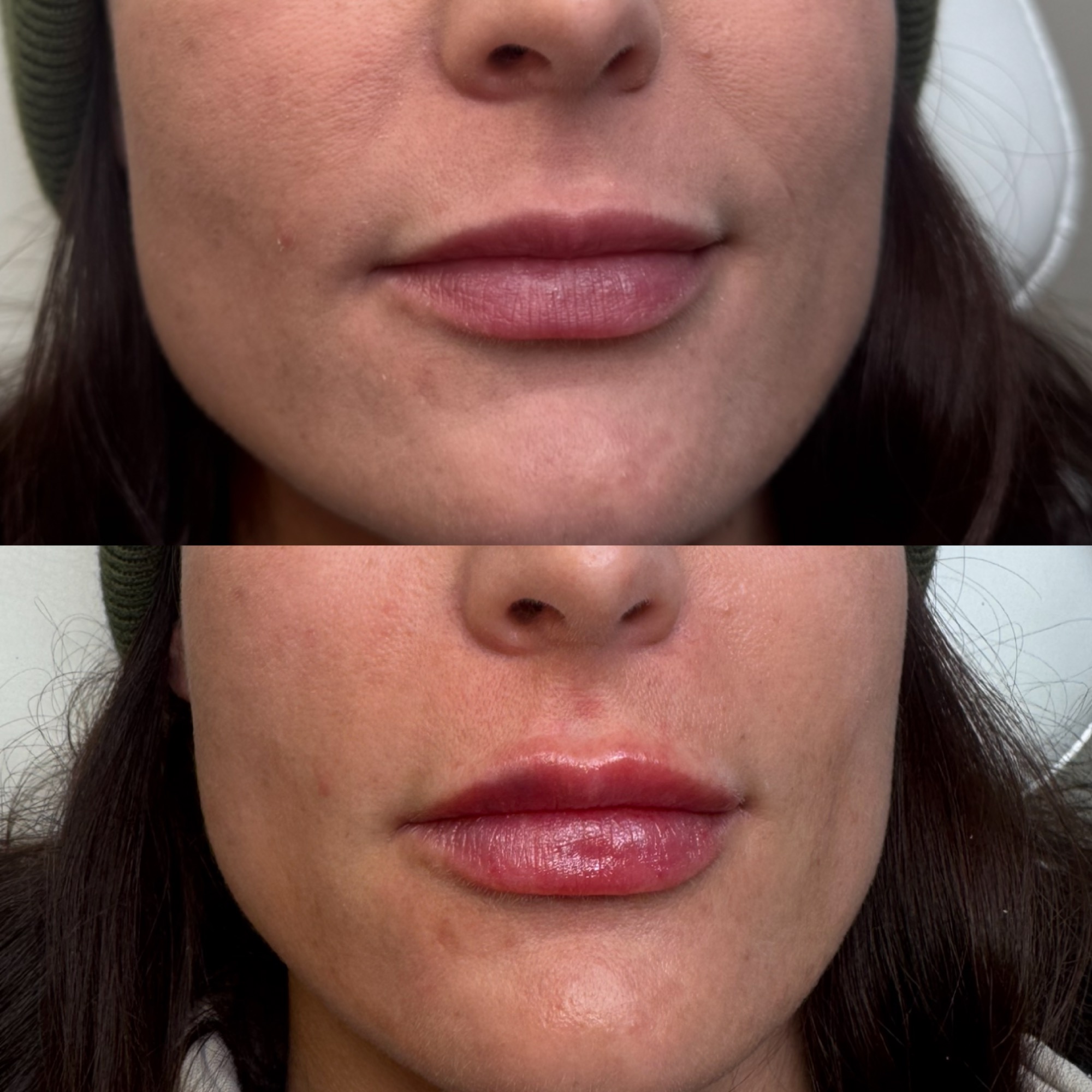 Lip filler before and after — soft plump, Clearwater FL