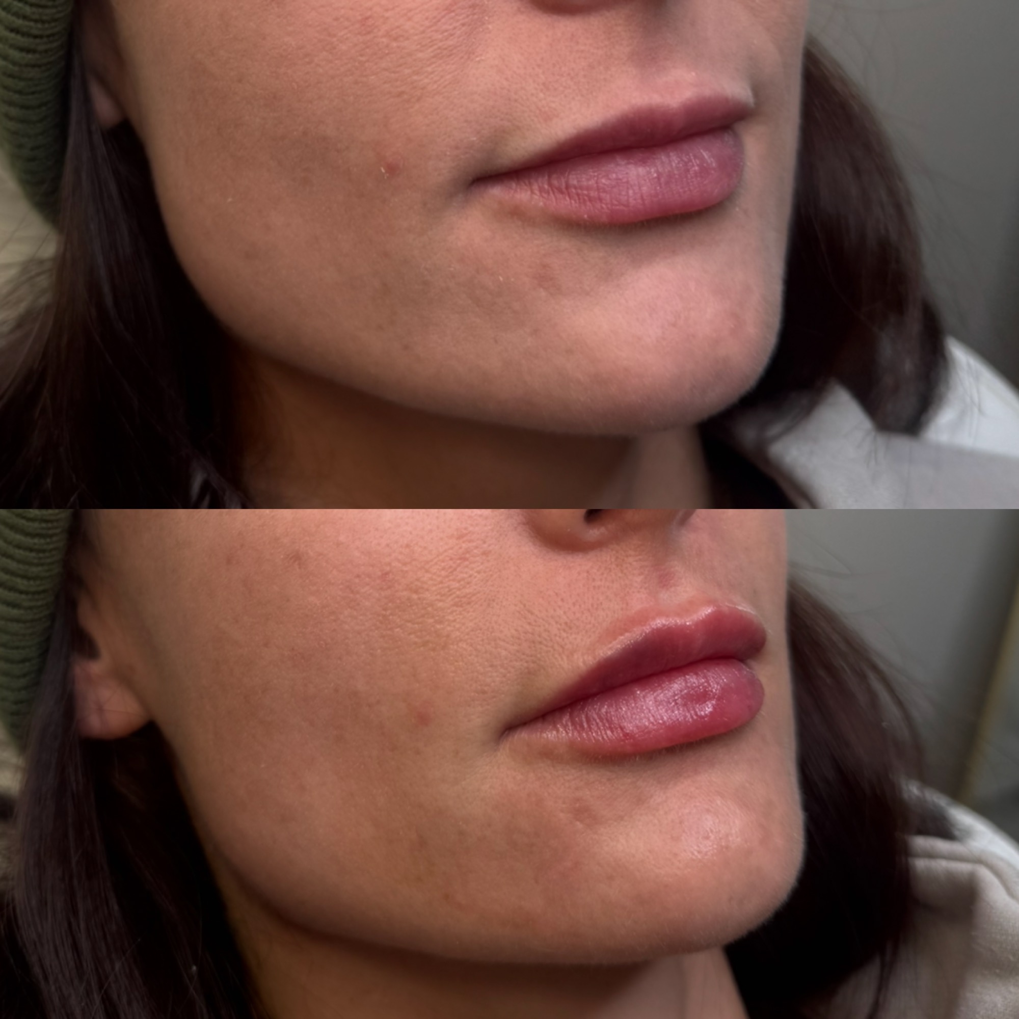 Lip filler before and after — natural fullness, Clearwater FL