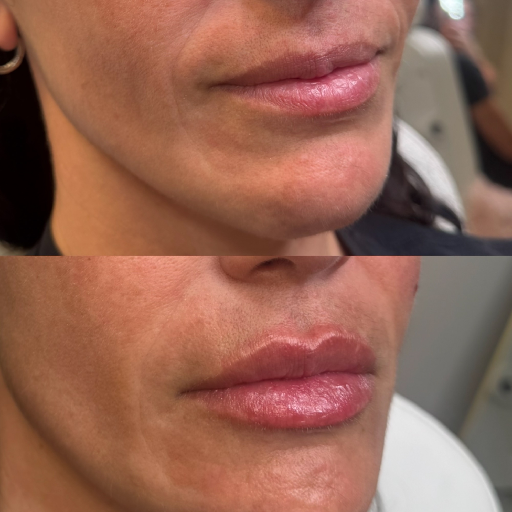 Lip filler before and after — hydrated and lifted, Clearwater FL