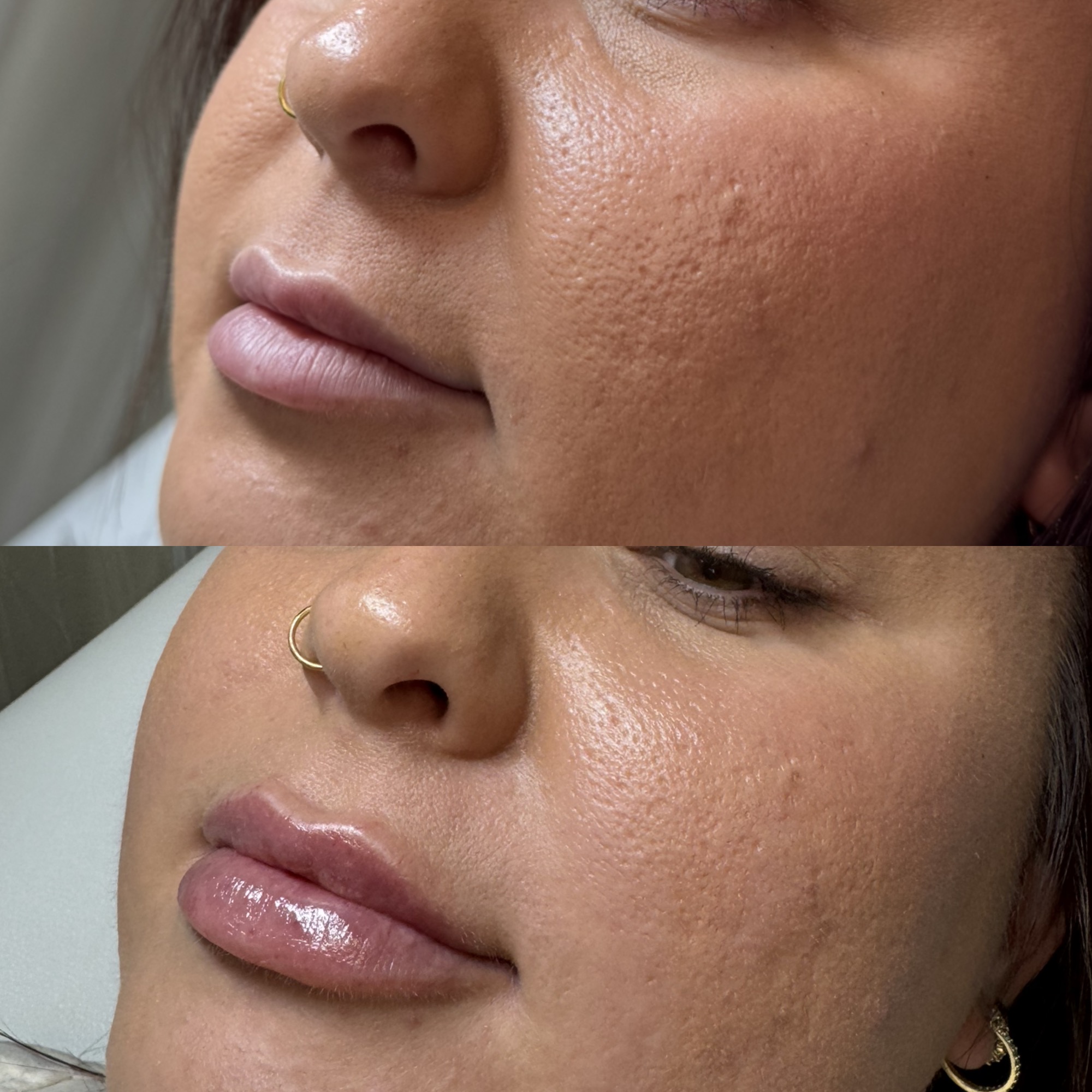 Lip filler before and after — glossy plump, Clearwater FL