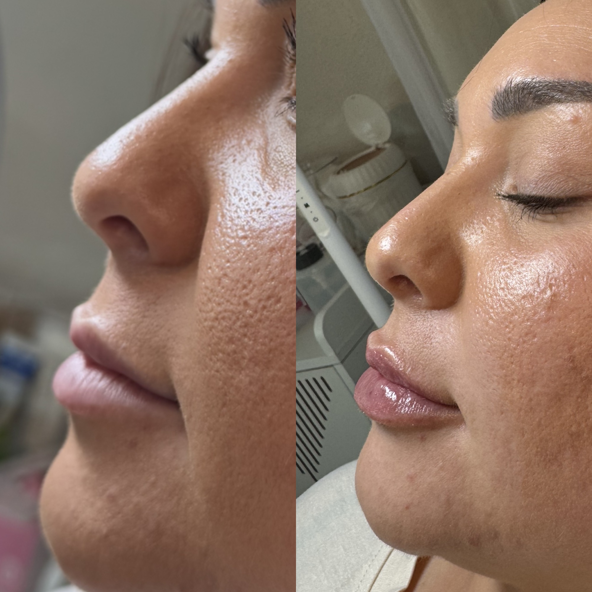 Lip filler before and after — side profile volume, Clearwater FL