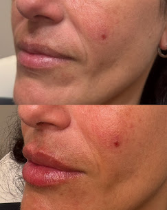 Lip Filler · Natural Volume before and after at Eternal Beauty Lifestyle Clearwater Spa