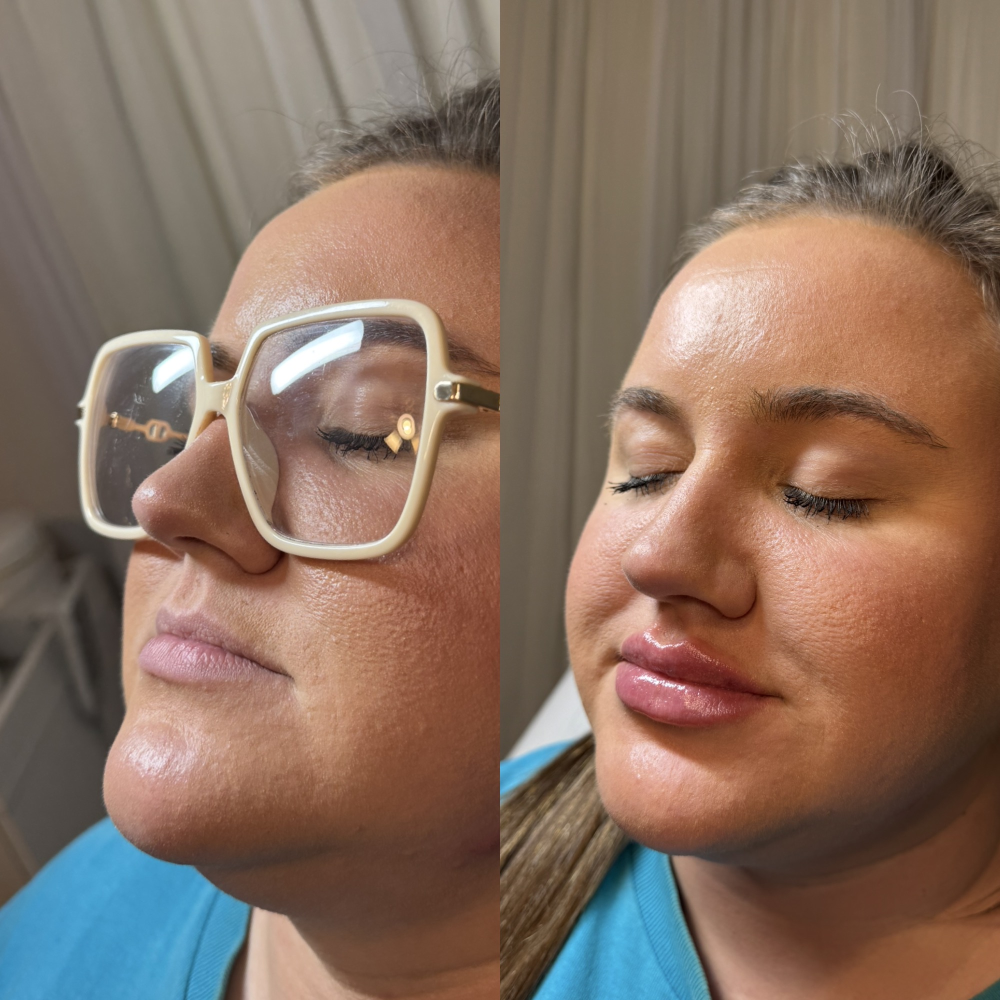 Lip filler before and after — glossy fullness, Clearwater FL