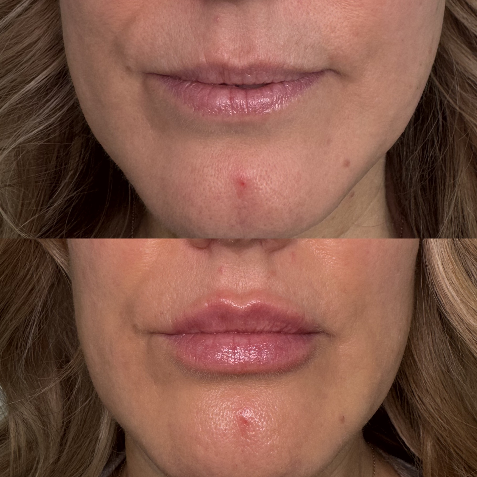 Lip filler before and after — front view added volume, Clearwater FL