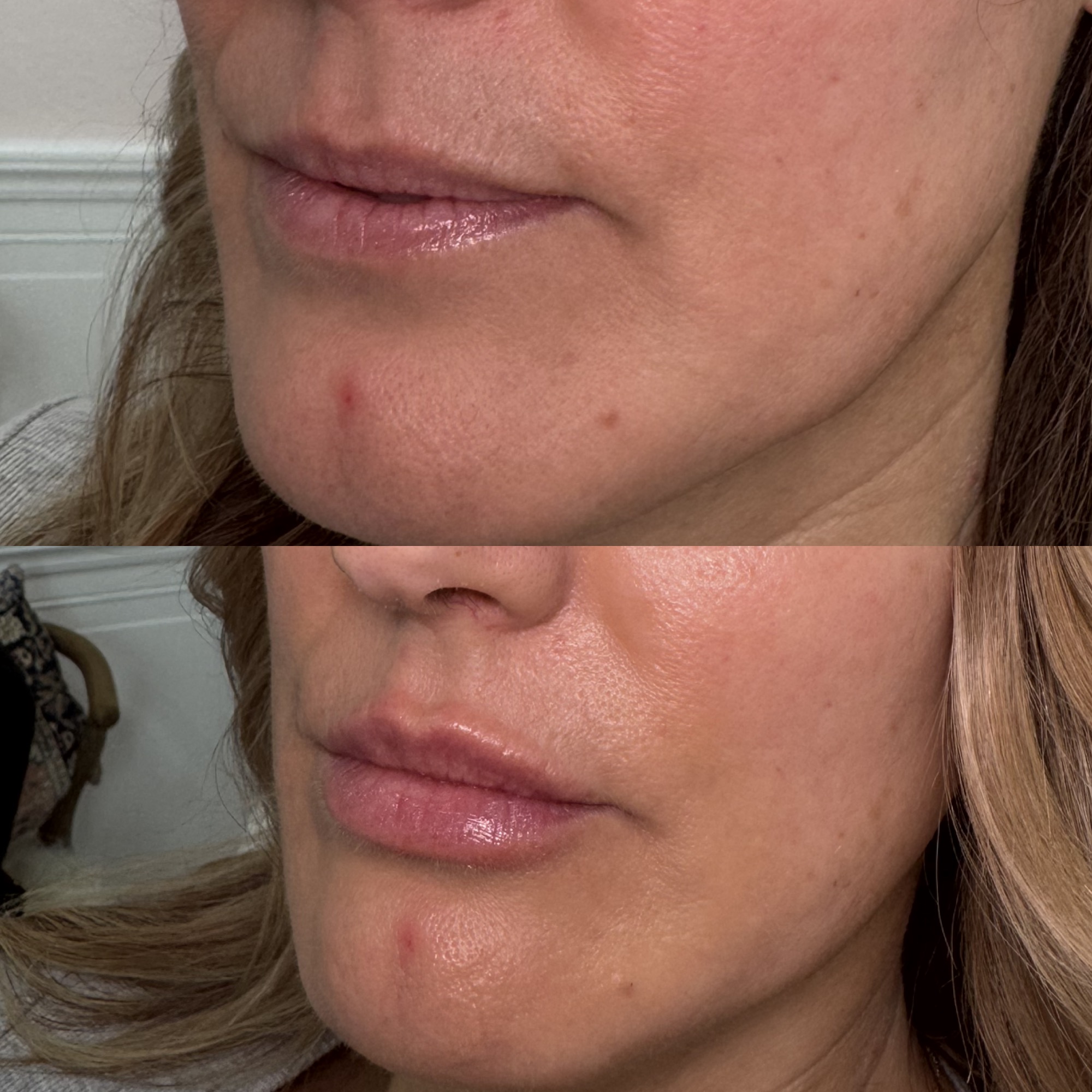 Lip filler before and after — three-quarter angle, Clearwater FL
