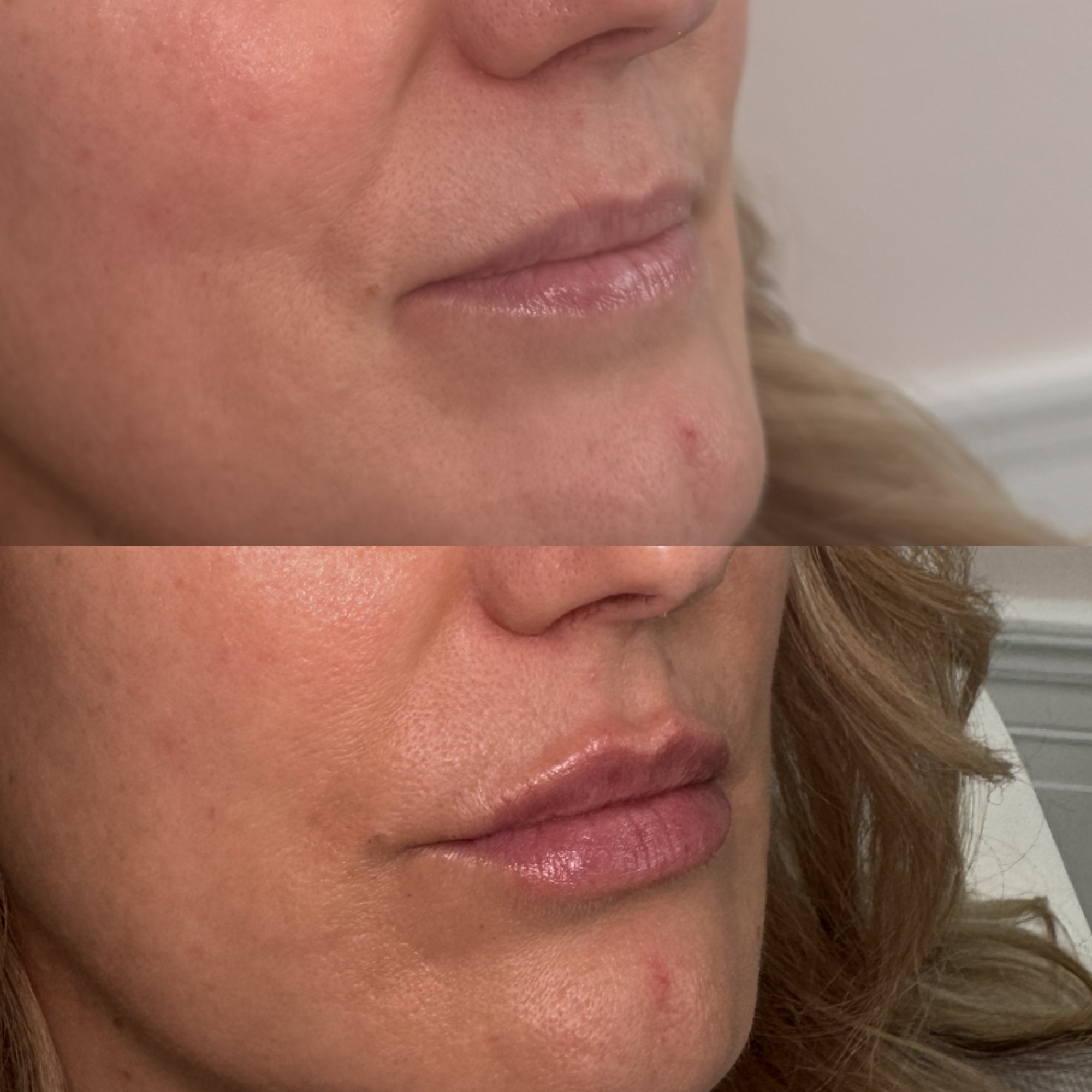 Lip filler before and after — soft natural shape, Clearwater FL