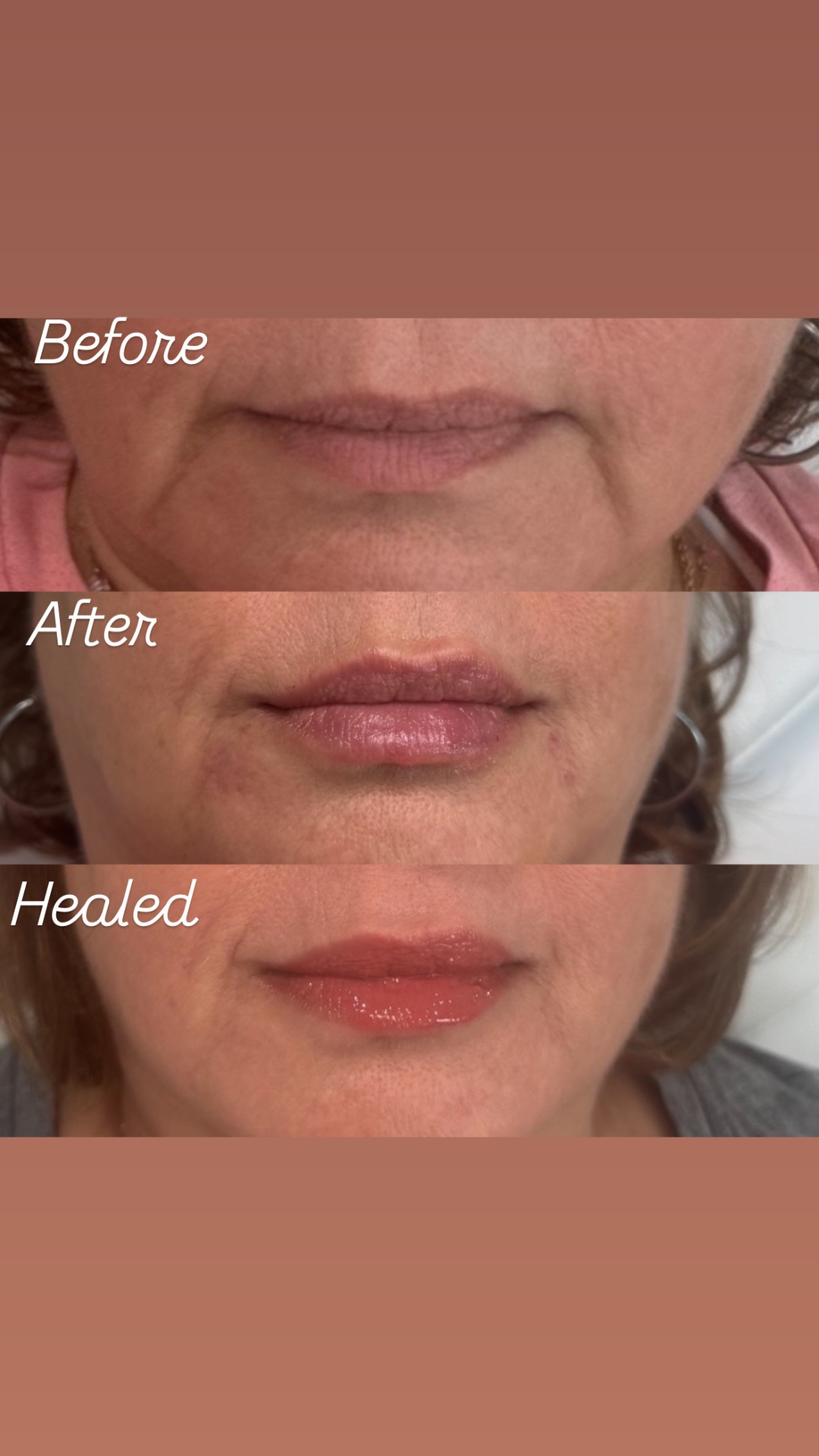 Lip filler before, after & healed progression — Clearwater FL