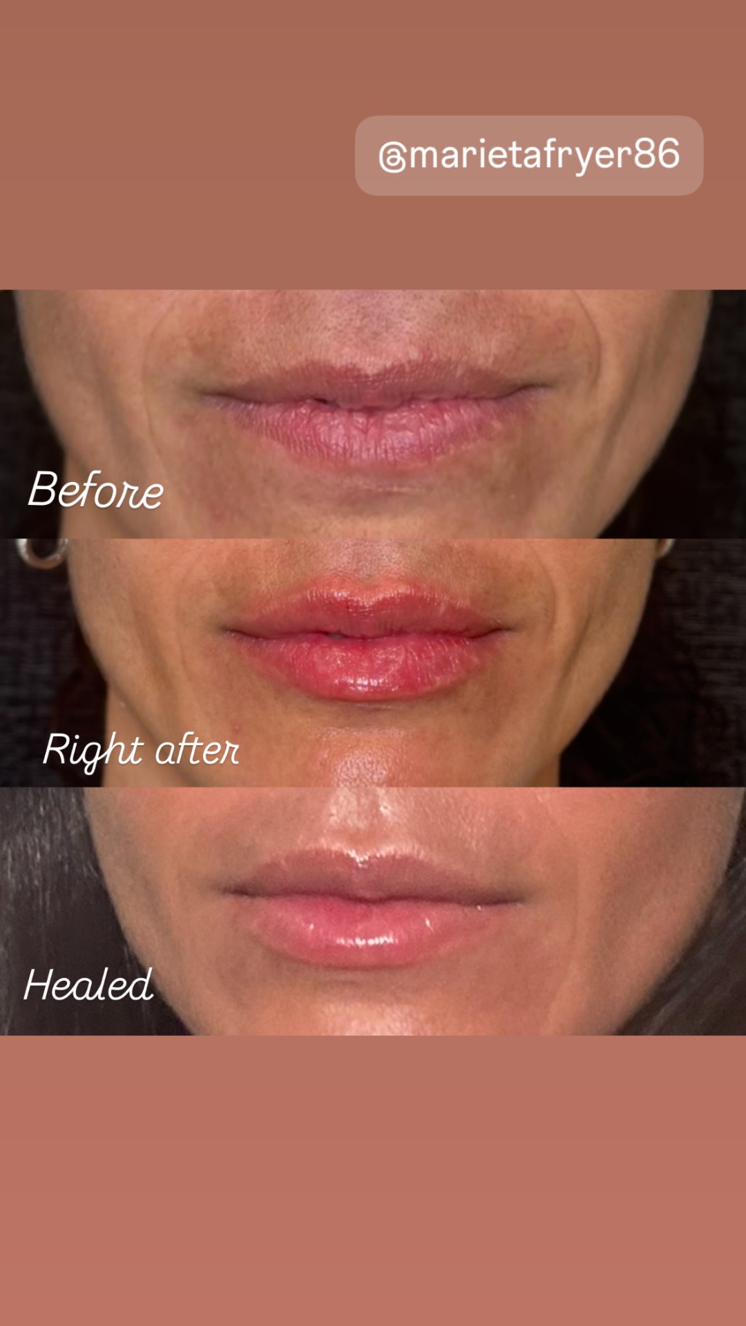 Lip filler before, right after and healed — Clearwater FL