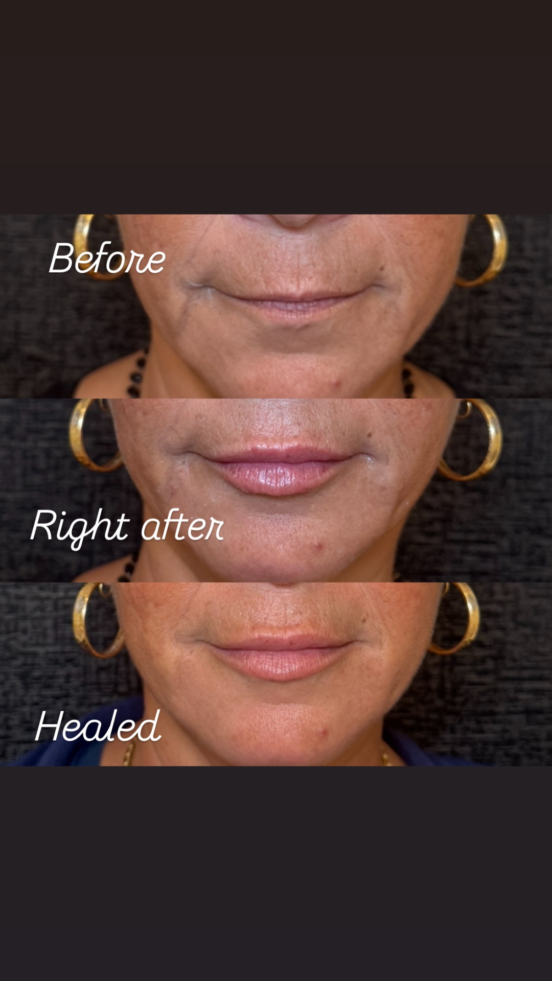 Lip filler progression before, right after and healed — Clearwater FL