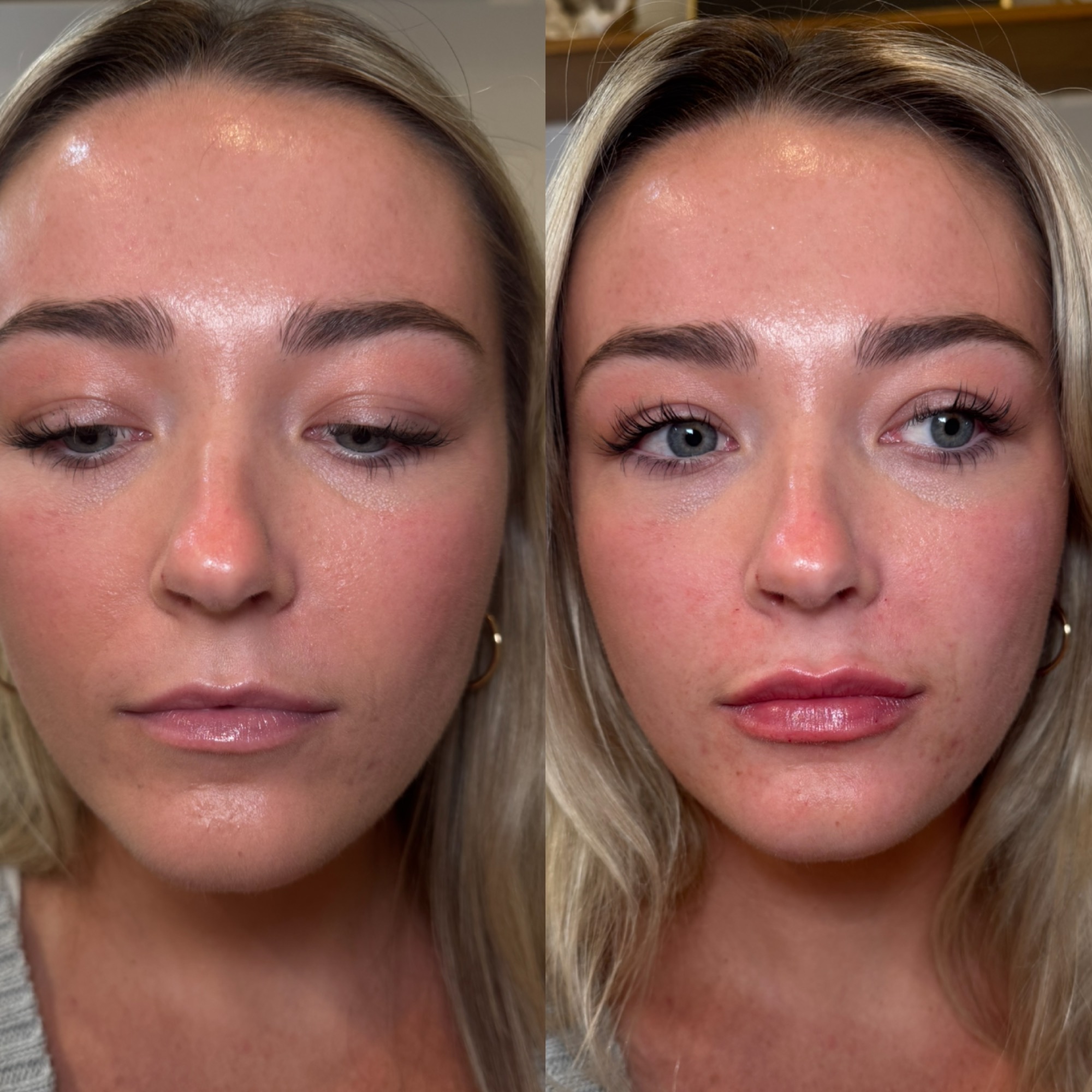 Lip filler before and after — natural plump, Clearwater FL